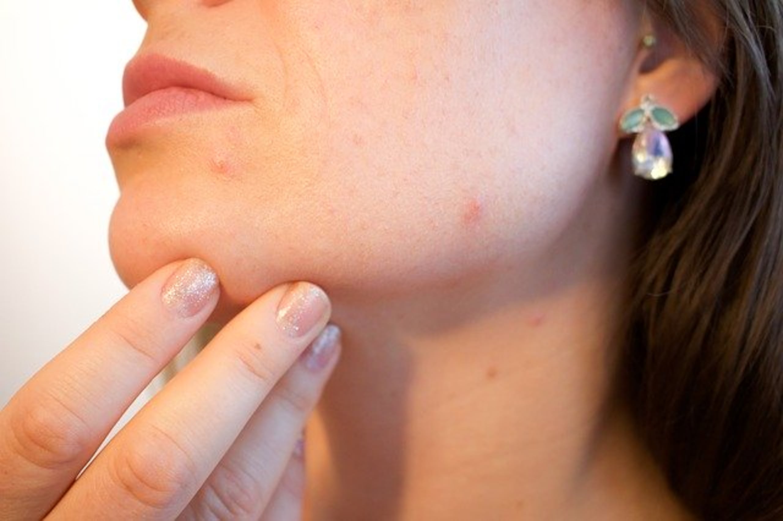 Como una respuesta al estrés, el cuerpo genera una mayor producción de hormonas que aumenta la producción de grasa del rostro, lo que bloquea el poro, ocasionando acné. (Pixabay)