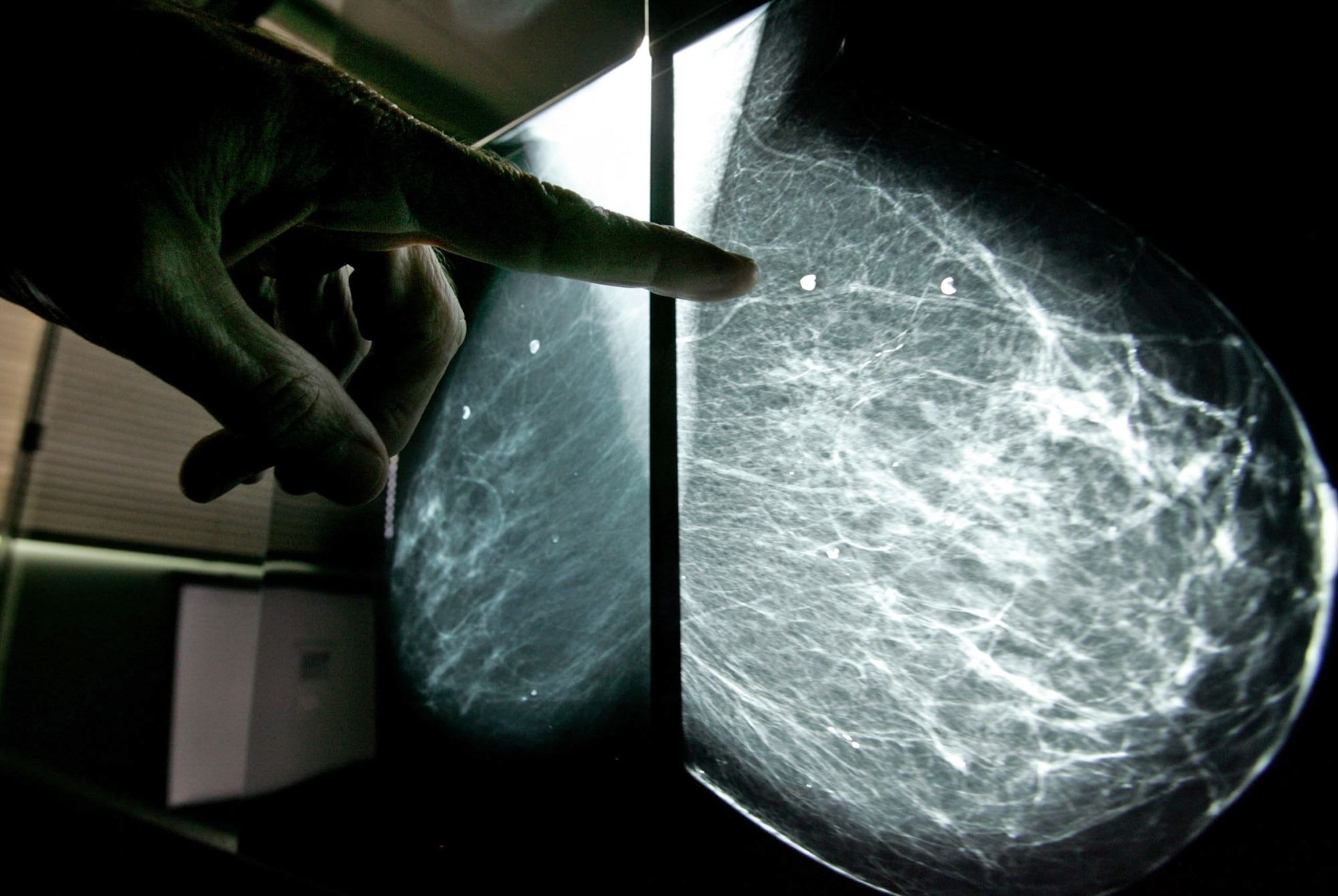 De acuerdo con las estadísticas del Registro de Cáncer de Puerto Rico, que datan del 2008, el cáncer de mama es el más común entre las mujeres. (Archivo / GFR Media)