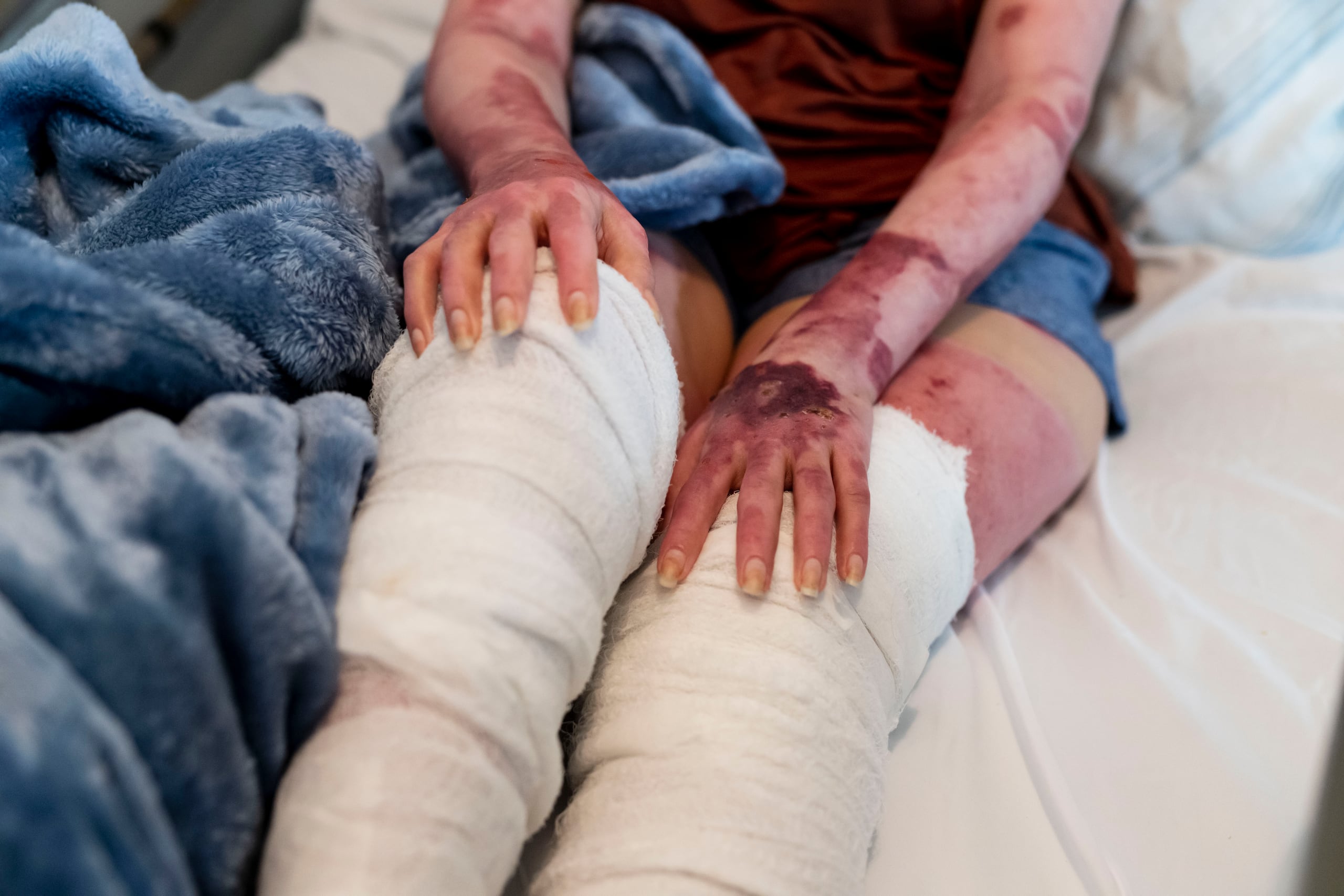 El servicio aportará a que los pacientes con cicatrices por quemaduras severas en la piel tengan una mejor calidad de vida.