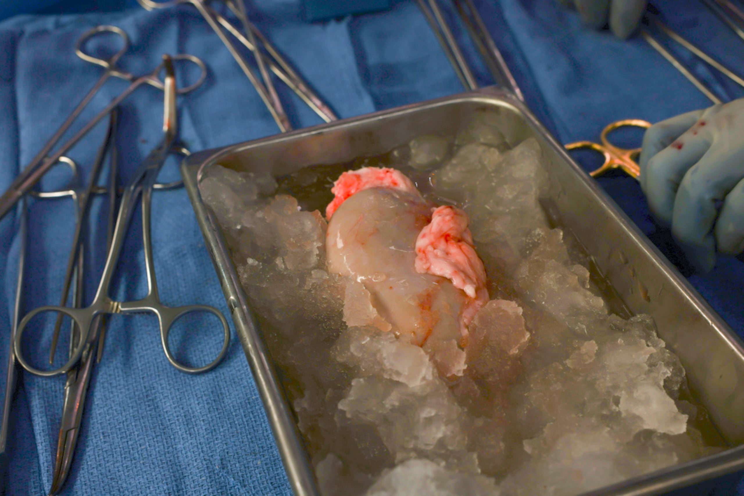 El riñón de cerdo sobre hielo, esperando ser trasplantado al paciente en el Hospital General de Massachusetts el 16 de marzo de 2024.