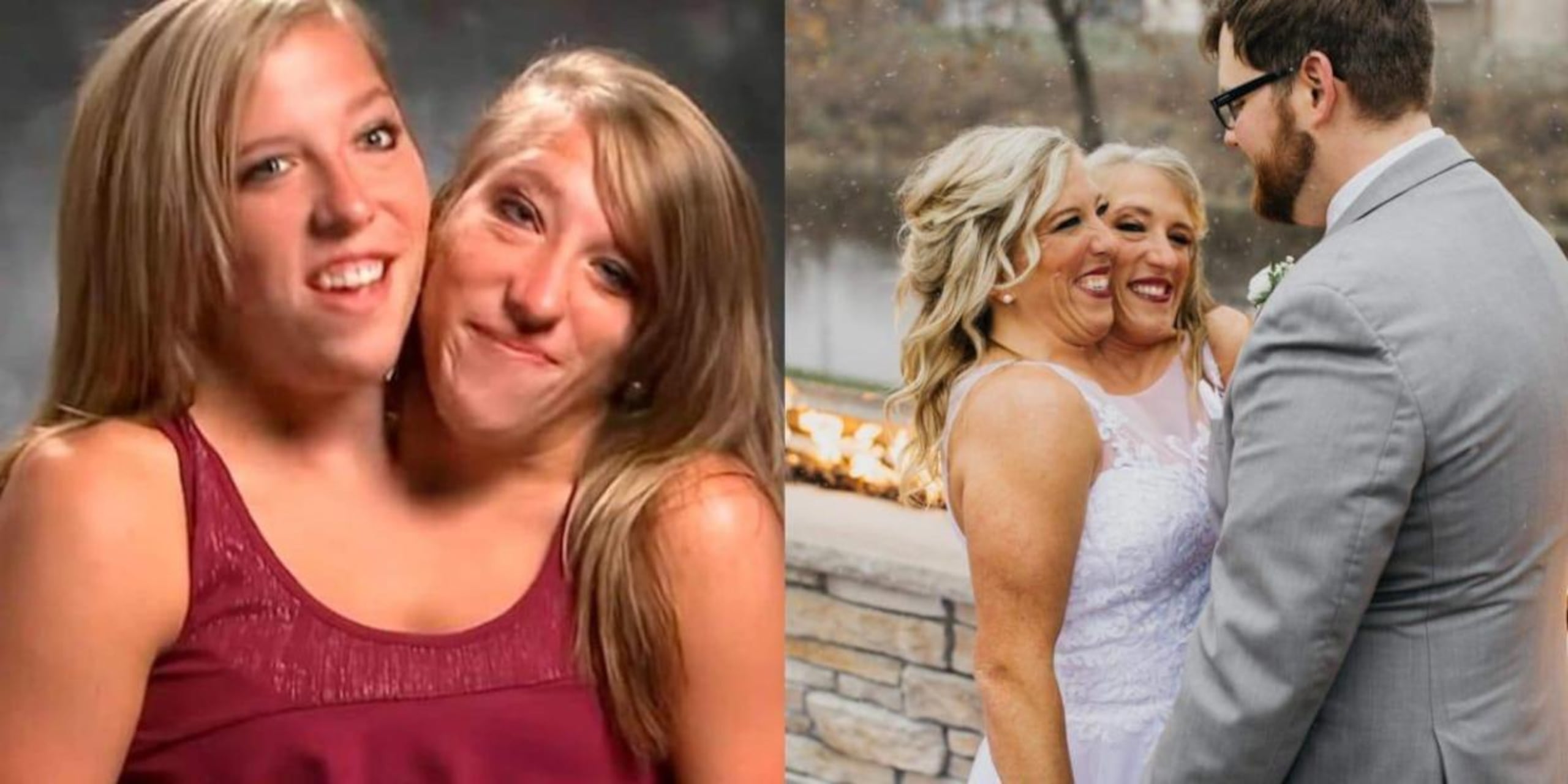 Las gemelas siamesas Abby y Brittany Hensel.