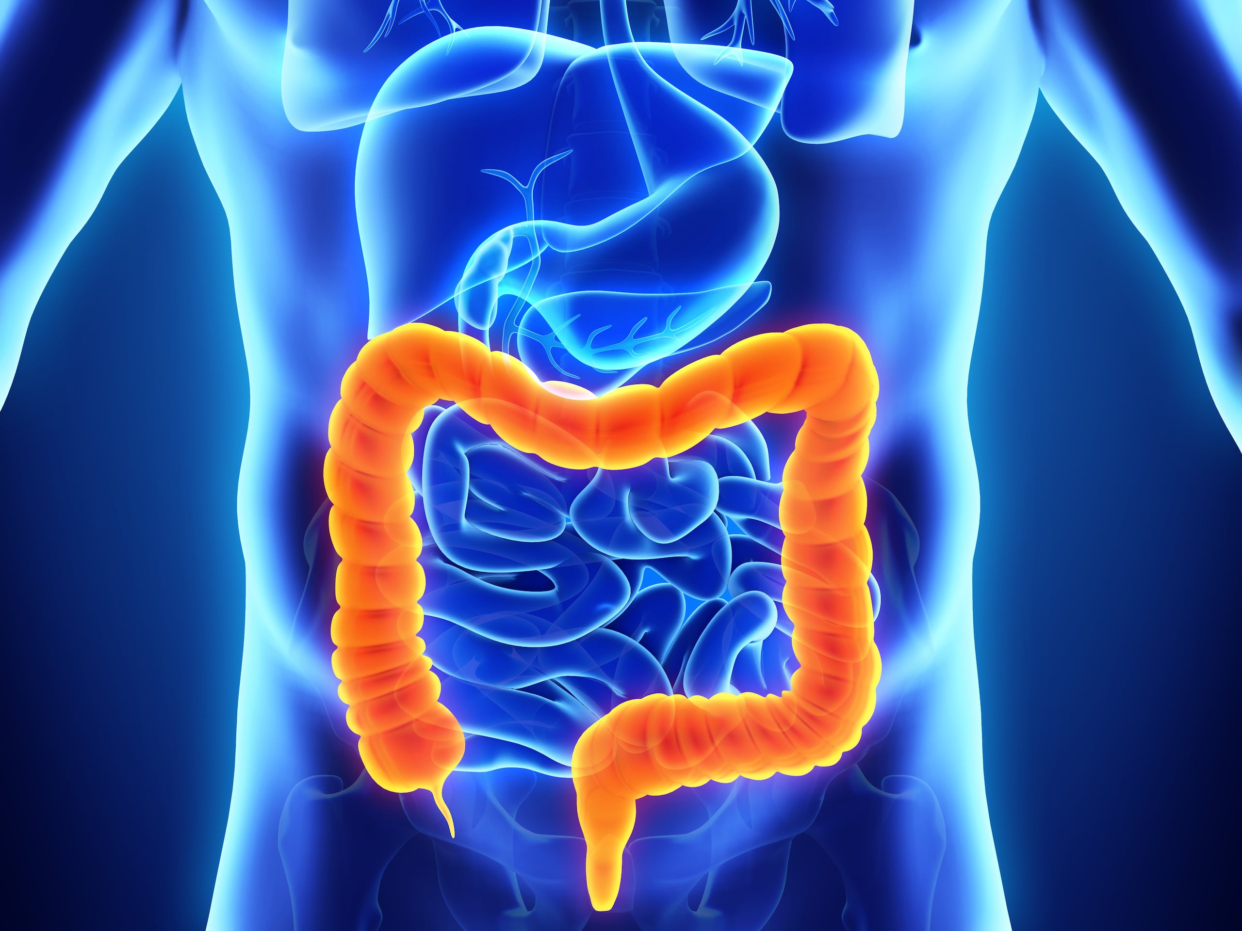 La combinación de inmunoterapia dual Opdivo® (nivolumab) y Yervoy® (ipilimumab) se usa para tratar el cáncer colorrectal estadio IV (metastásico).