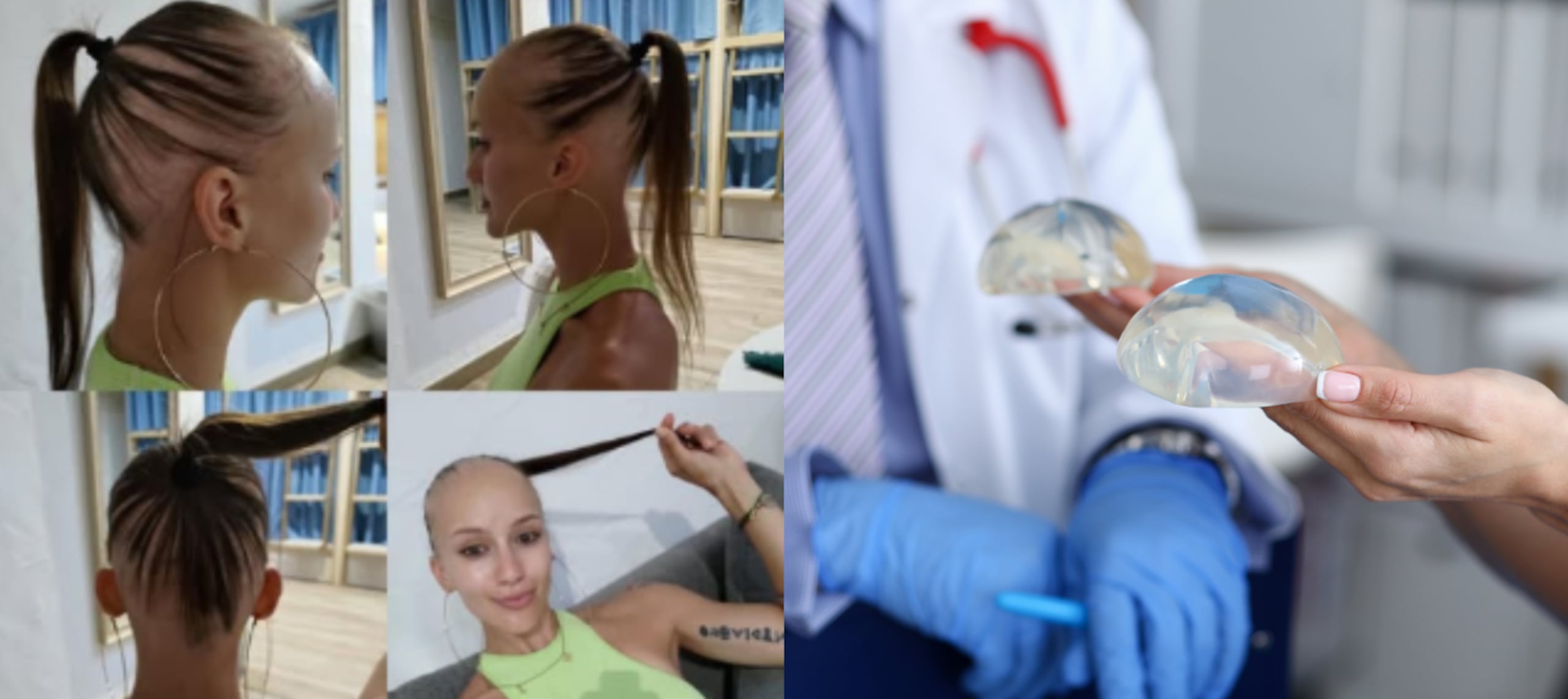 Los primeros síntomas que evidenció Barbora Kropackova luego de su cirugía estética.