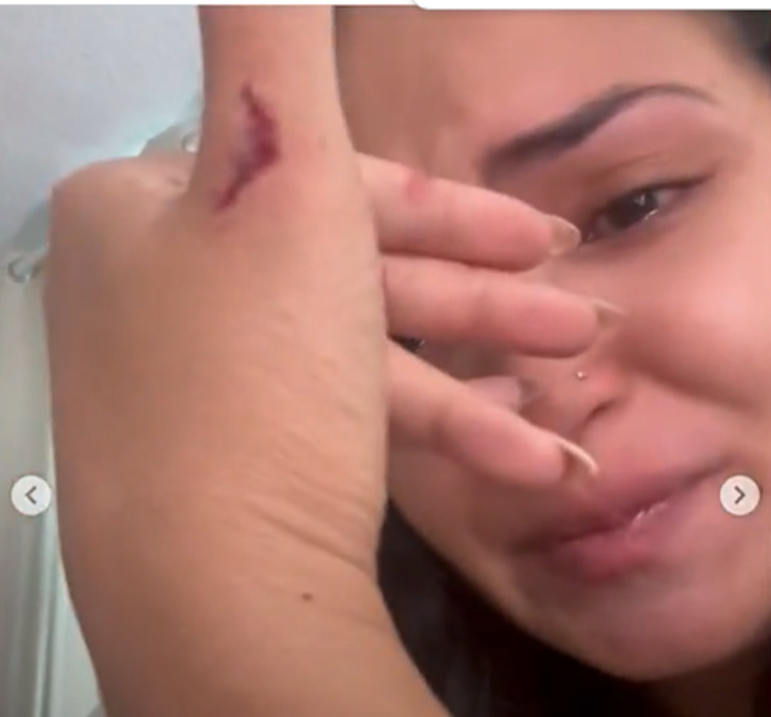 Eixchel Berroteran muestra sus heridas en redes sociales