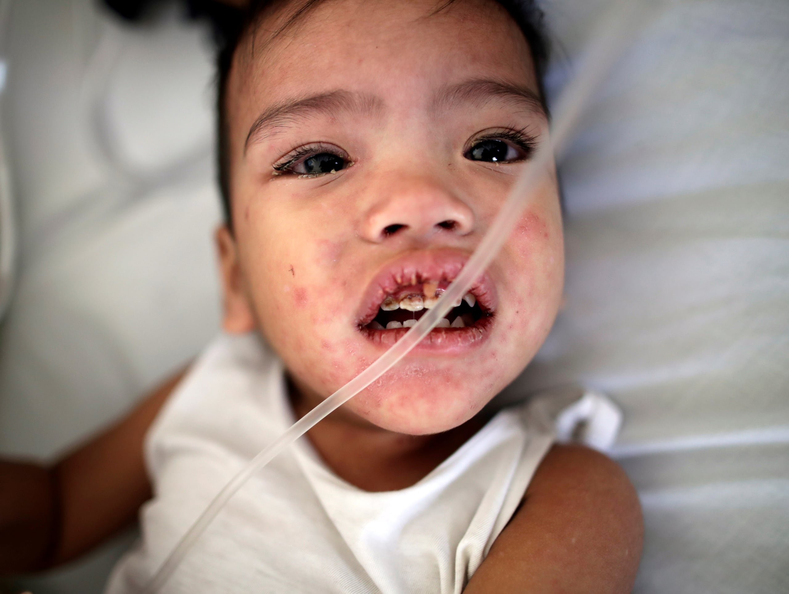 Los casos en Florida se reportan en medio de polémica porque el cirujano general estatal, Joseph Ladapo, anunció en septiembre pasado que el gobernador Ron DeSantis, "trabajará para poner fin a todos los mandatos de vacunación establecidos por la ley".