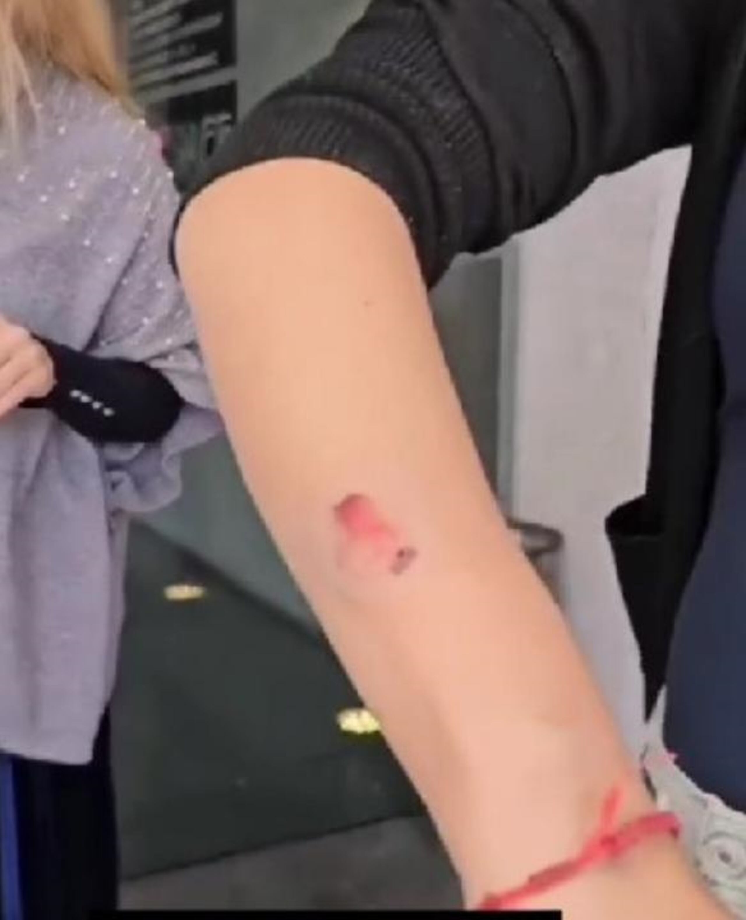 Durante el enfrentamiento, la mujer llegó a desprenderle un pedazo de piel a la manicurista.