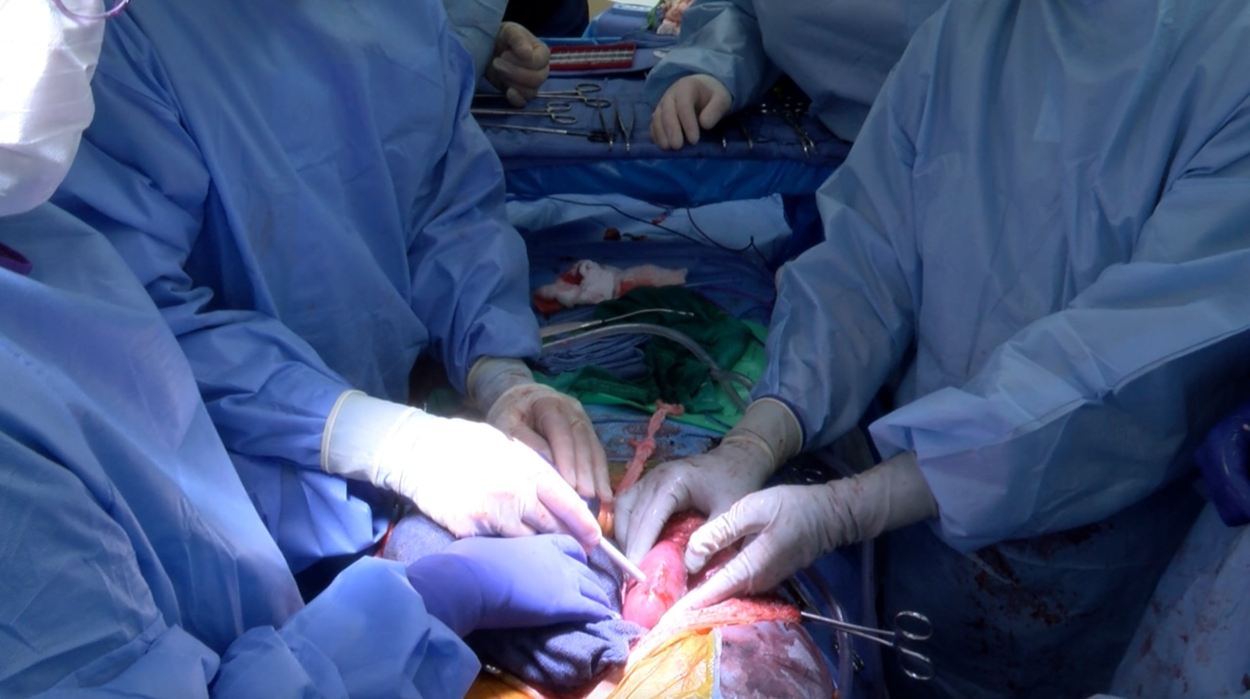El riñón, que procedía de un cerdo miniatura de Yucatán y fue modificado genéticamente para que fuera compatible con el sistema inmunitario, le fue trasplantado en enero de 2025 y pasó un año hasta que pudo acceder a uno humano.