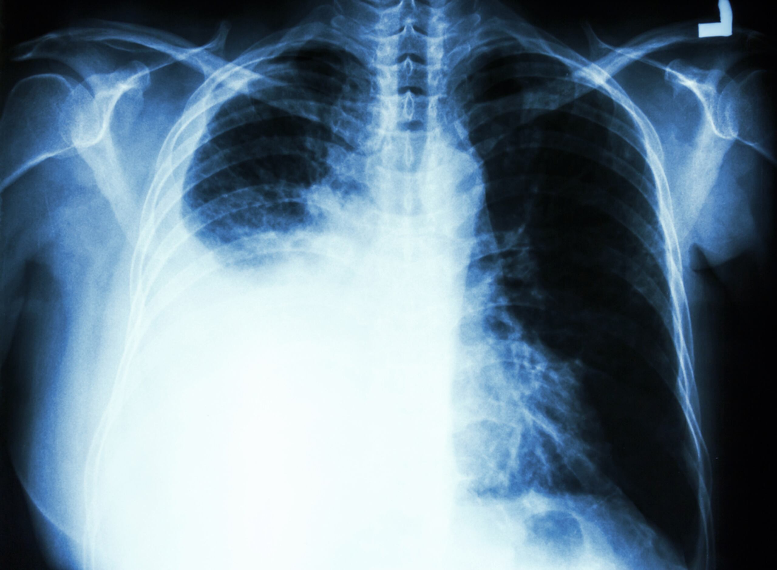 Cáncer de pulmón