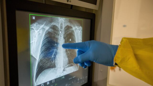 Diagnóstico temprano y prevención, pilares para mejorar salud pulmonar en América Latina