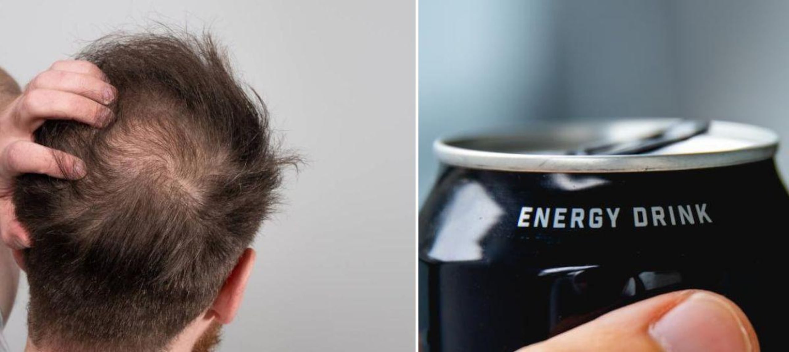 Las bebidas azucaradas pueden ocasionar calvicie.