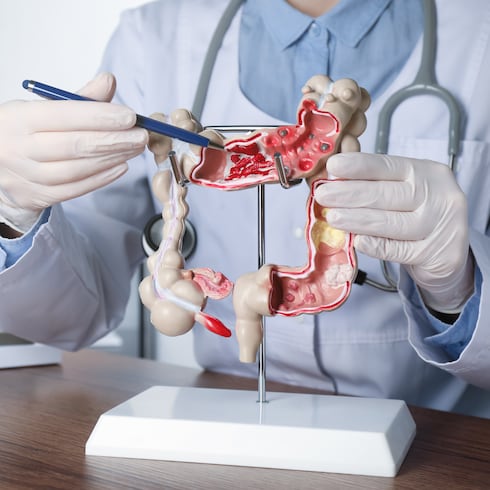 FOTOS: Estos son los países en América Latina con mayor prevalencia de cáncer de colon