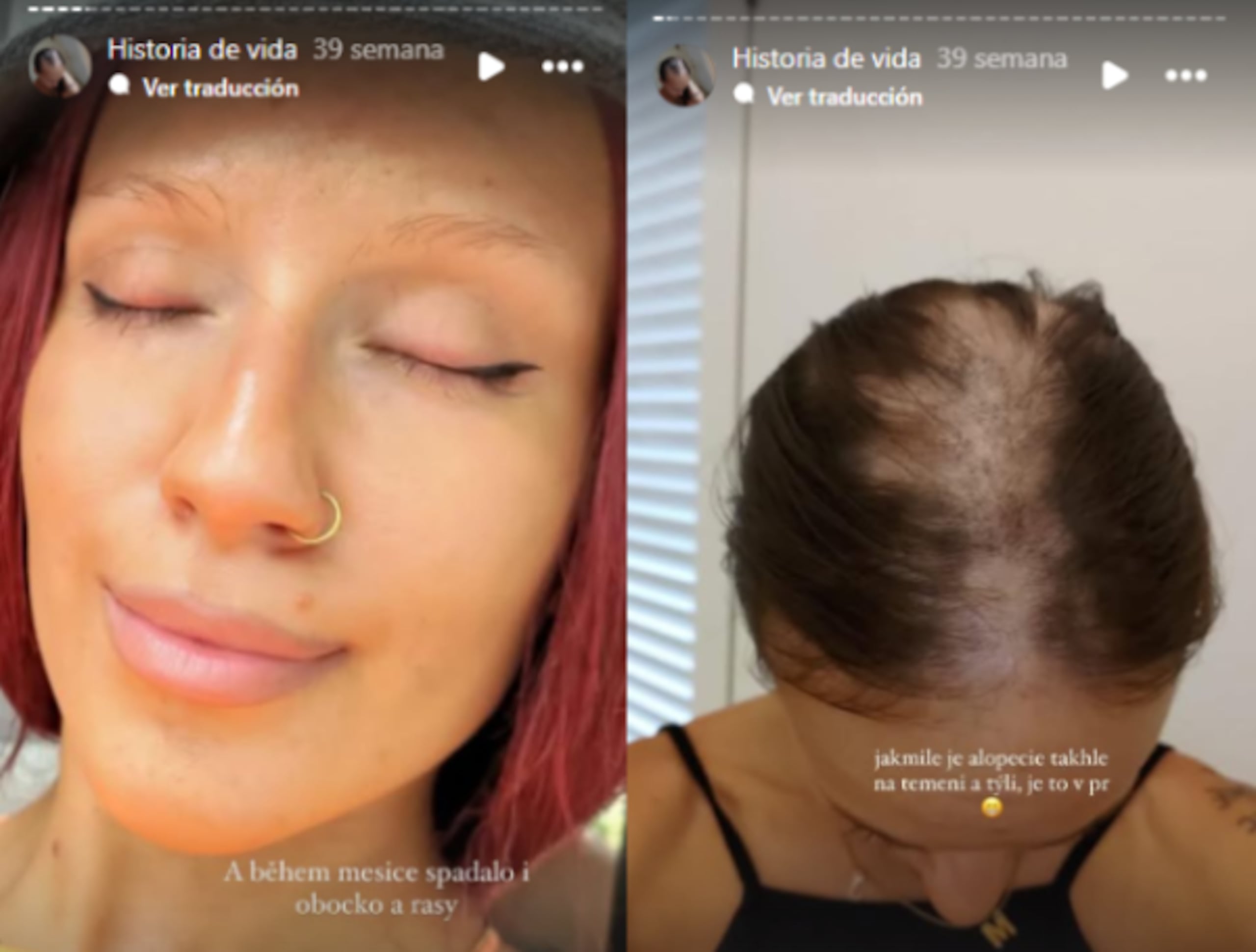 En menos de un mes perdió la mayoría de su cabello.