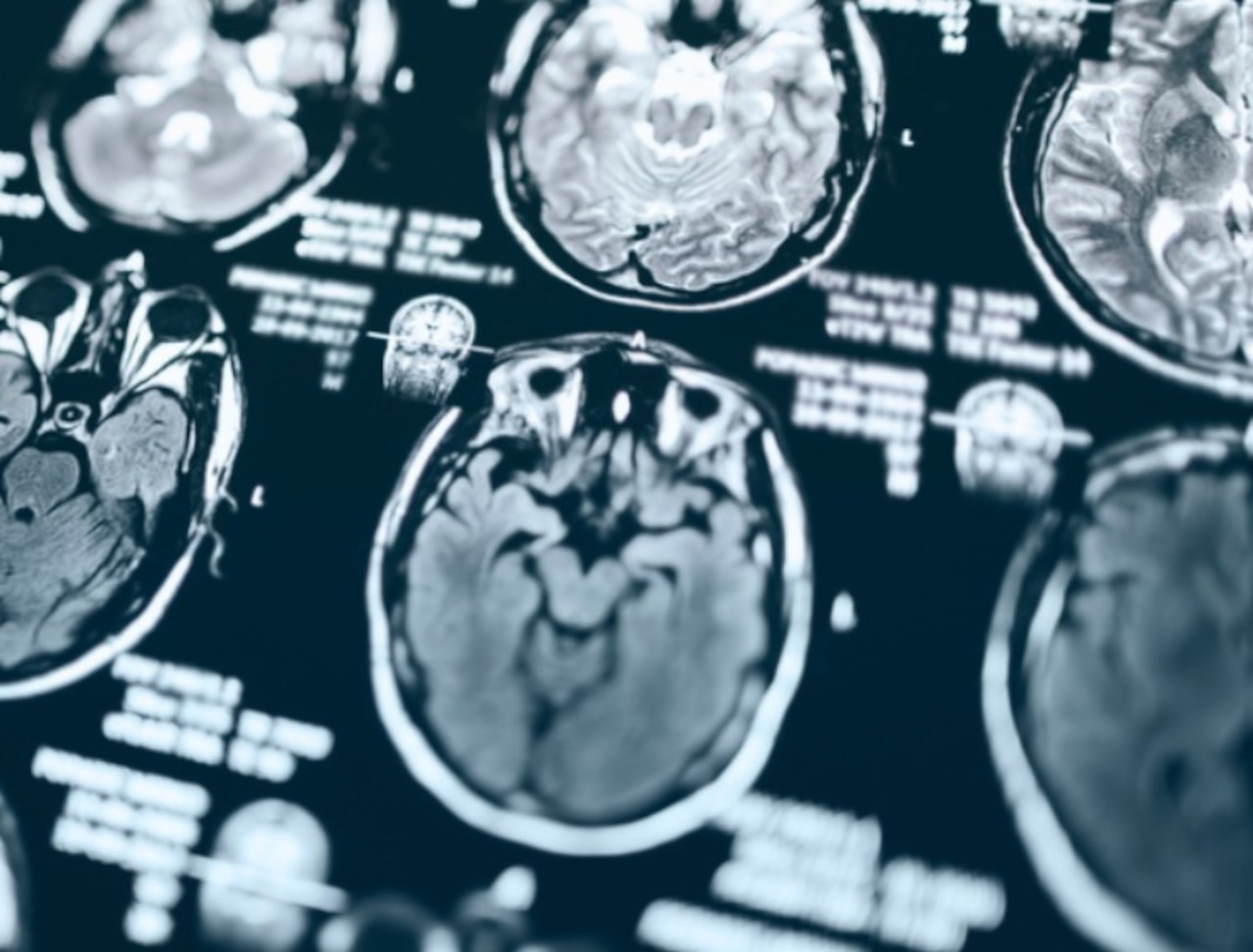 La fase final afecta el cerebro basal, encargado de regular respiración, pulso y metabolismo.