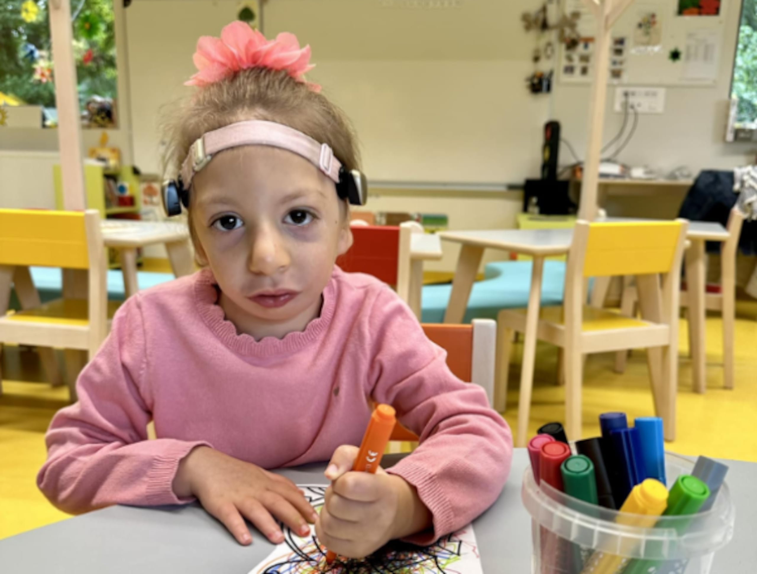 Margot nació con disostosis mandibulofacial-microcefalia.