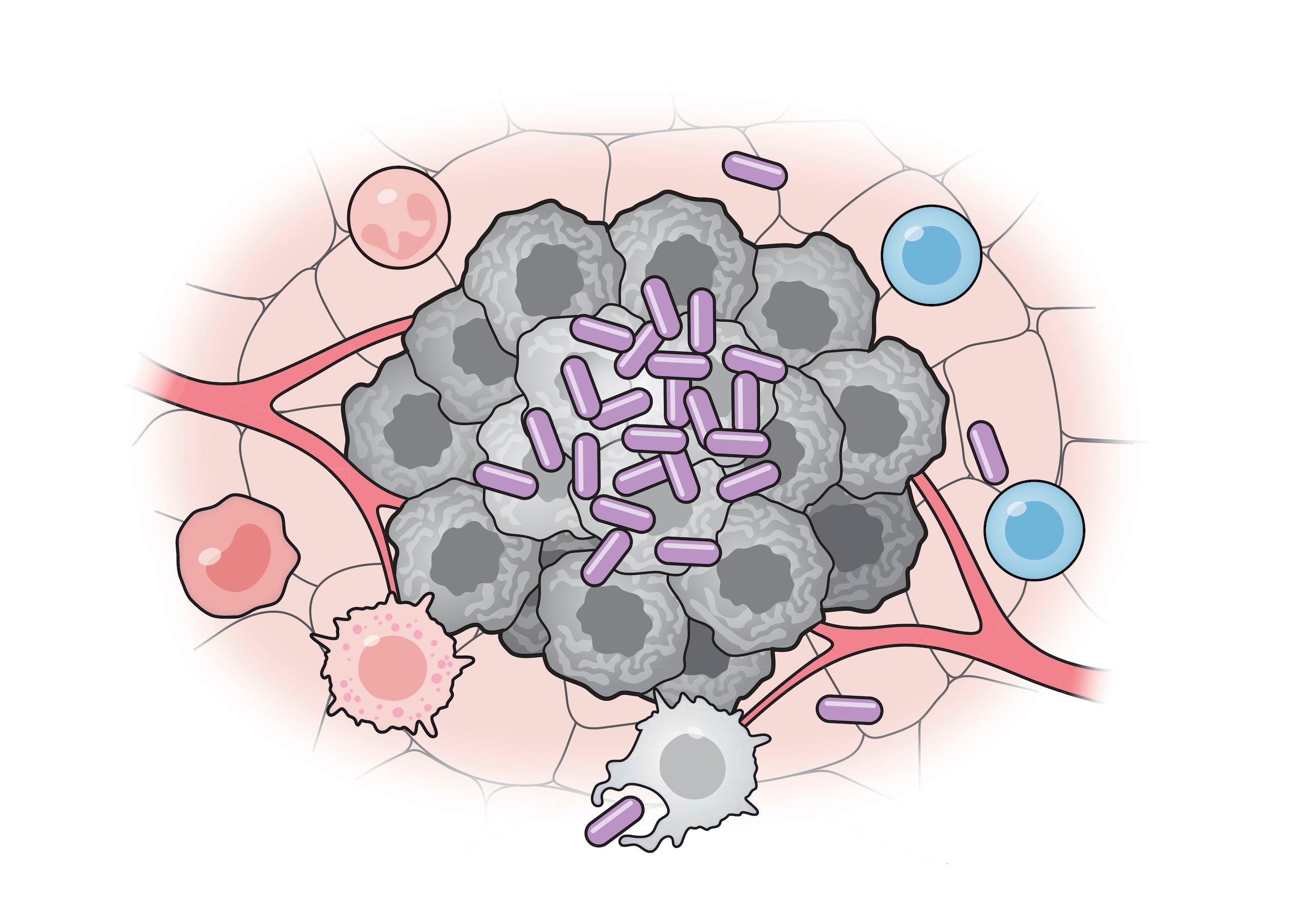 Células bacterianas artificiales (púrpura) activan varias partes del sistema inmunitario para atacar a las células tumorales (gris).
Crédito: Universidad de Columbia