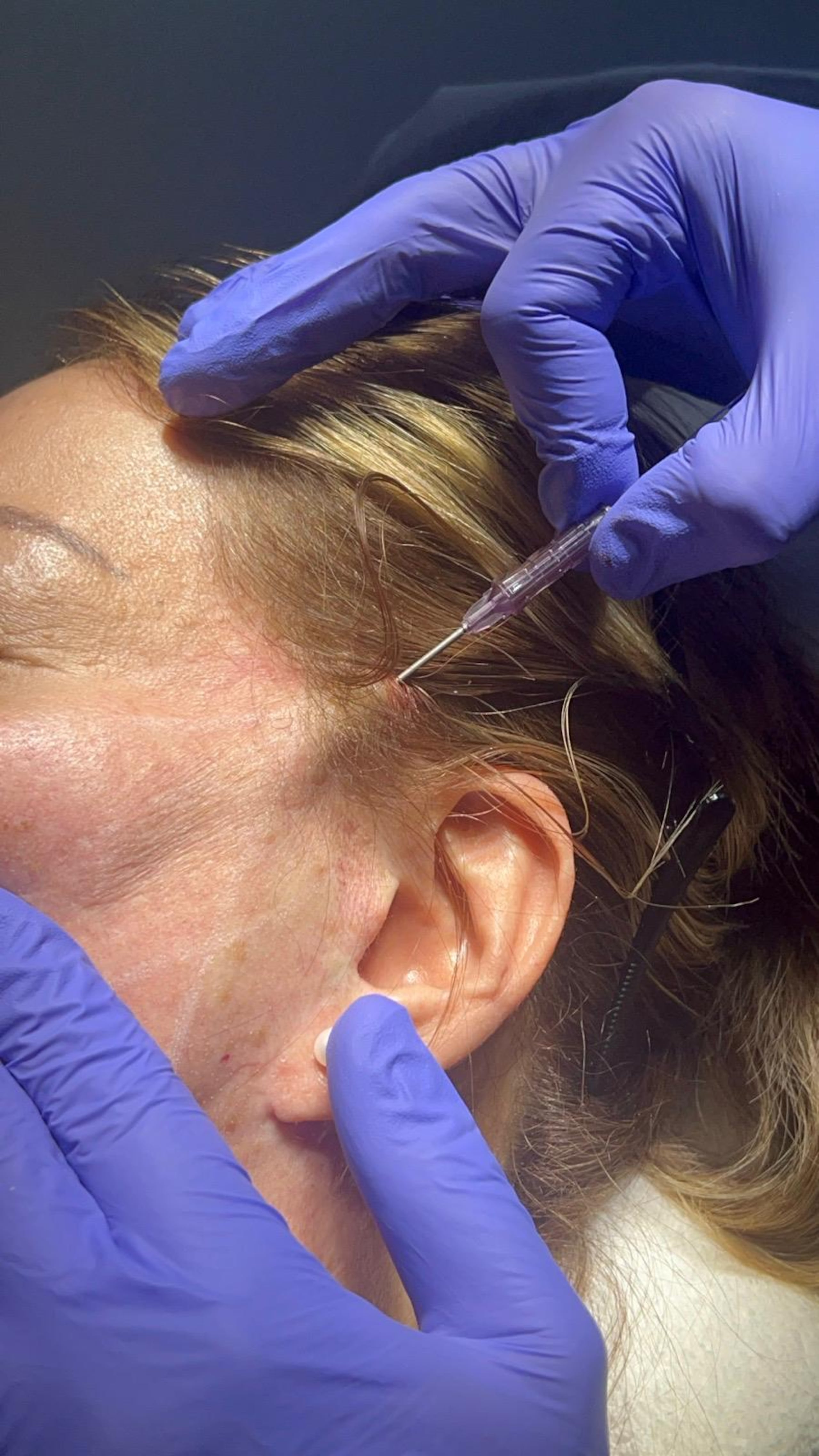 Este tratamiento se trata del único aprobado por la Administración de Alimentos y Medicamentos de Estados Unidos en proveer levantamiento facial con menor intervención quirúgica.