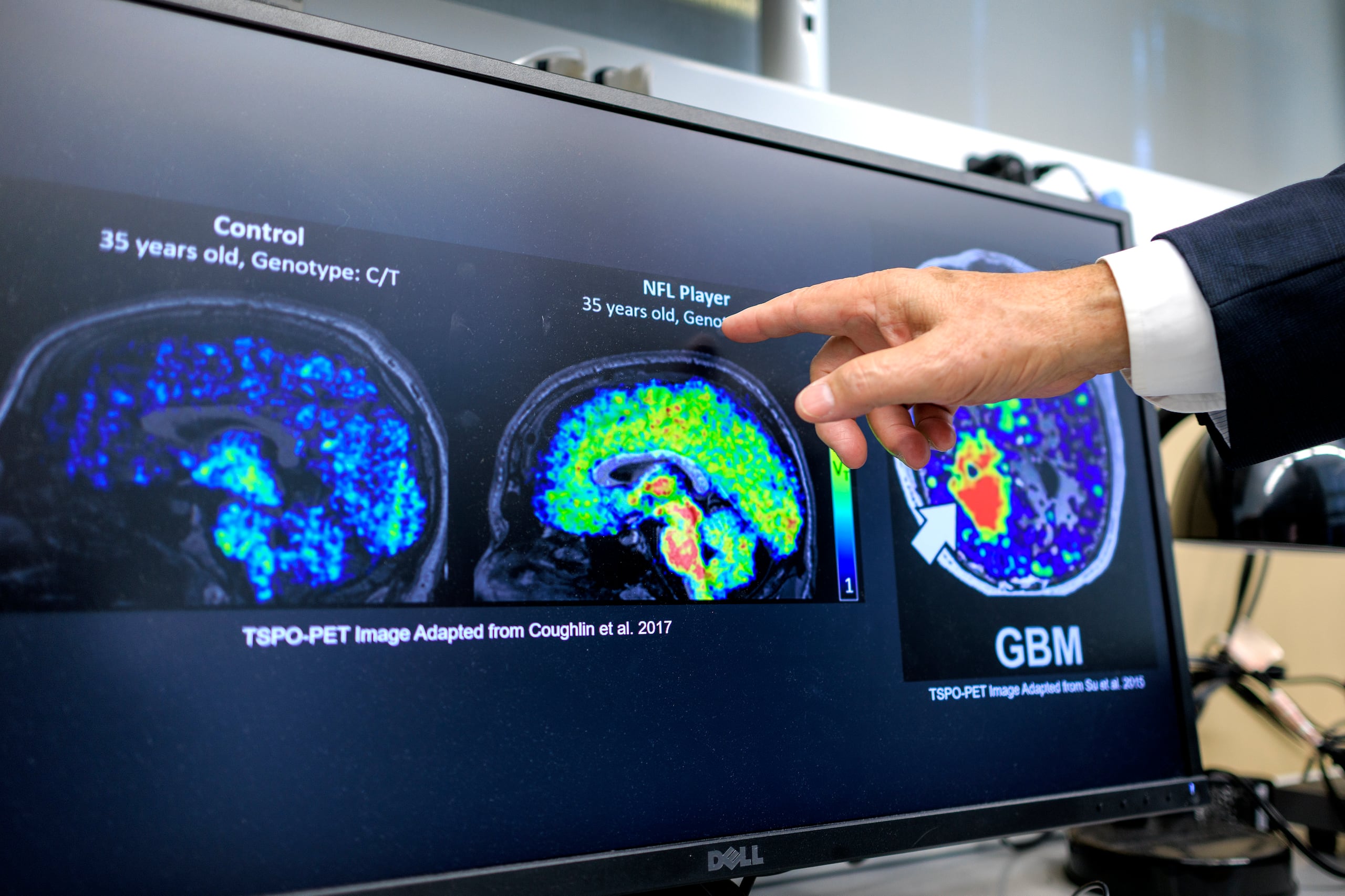 Guilarte y su equipo usaron un software especial de imagen que detectó niveles elevados de TSPO en ratones modificados genéticamente con Alzheimer familiar desde las seis semanas de edad, lo que equivale a entre 18 y 20 años en humanos. EFE/EPA/CRISTOBAL HERRERA-ULASHKEVICH