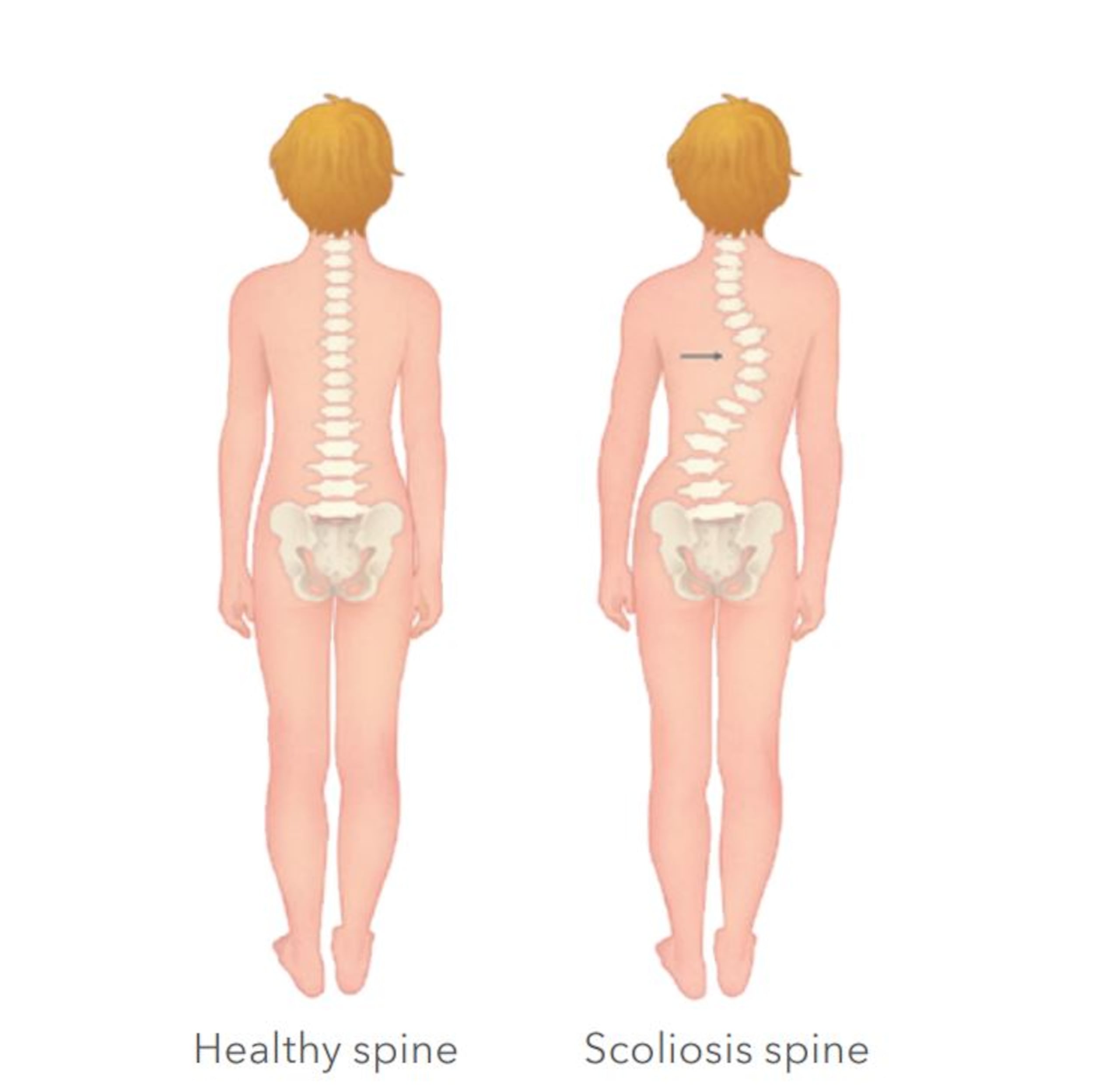 Inicialmente, la escoliosis se presenta como una pequeña curvatura en la columna, que es difícil de detectar cuando está empezando.