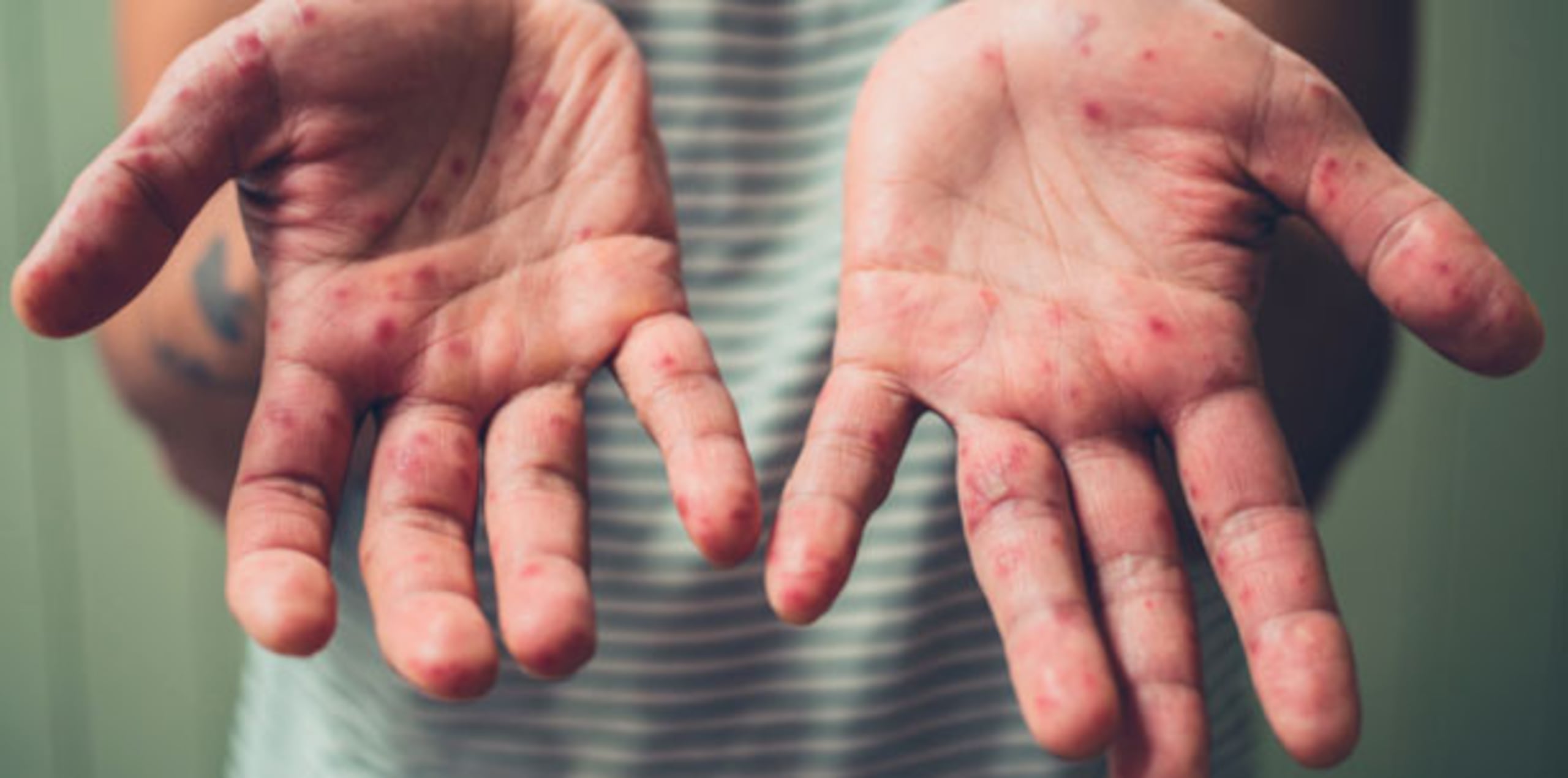 La vacuna contra el sarampión, disponible por primera vez en la década de 1960, es considerada segura y altamente efectiva. (Archivo)