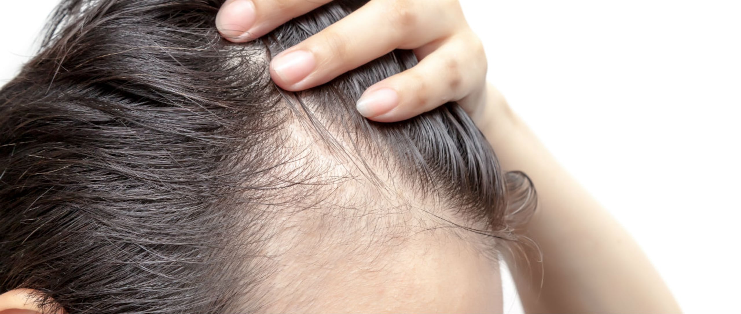 El estudio arroja luz sobre posibles maneras de frenar la caída del cabello y los daños cutáneos en humanos a través de medicamentos tópicos o de vía oral. (Shutterstock)