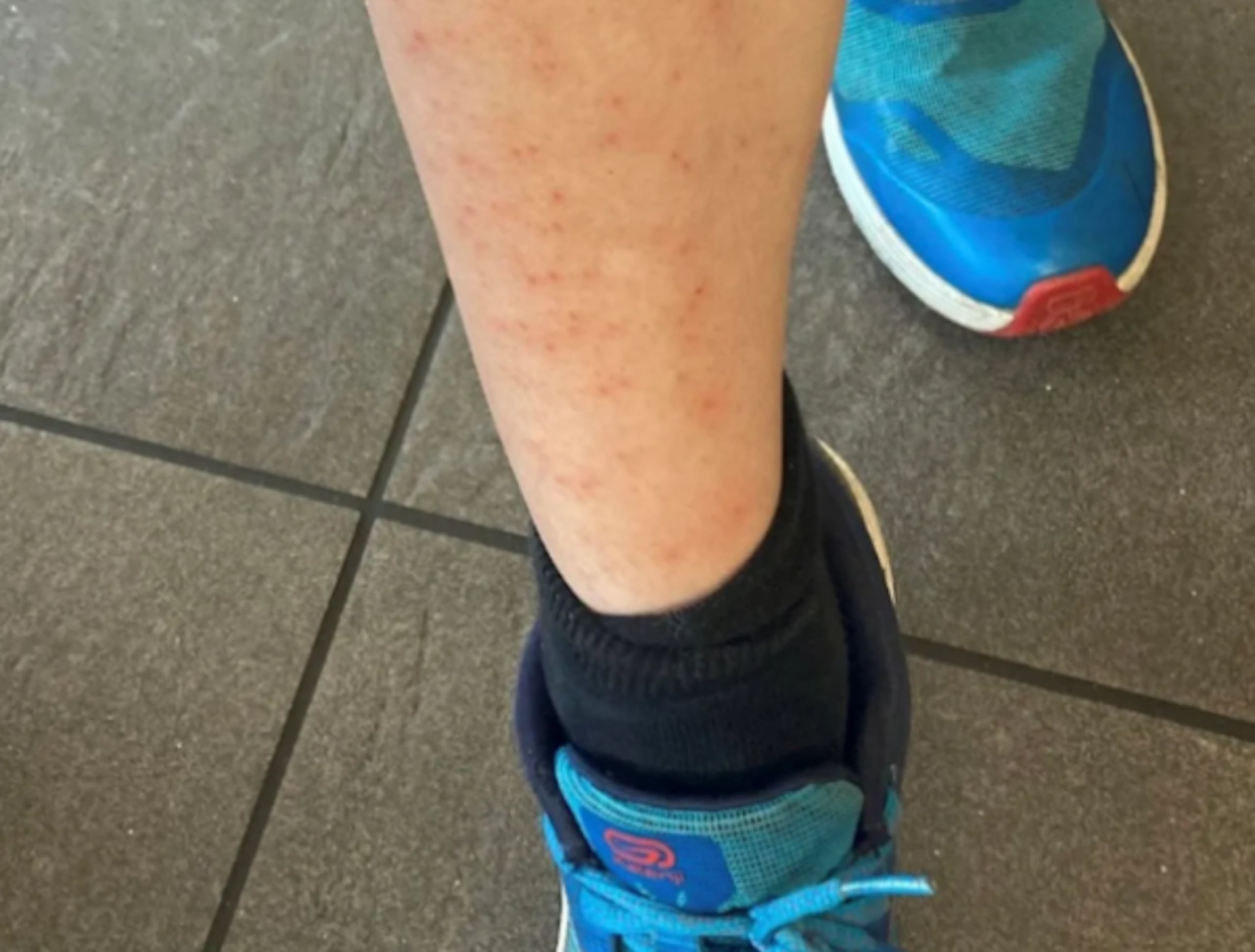 Estas condiciones afectan principalmente a personas con dermatitis atópica, se explicó.