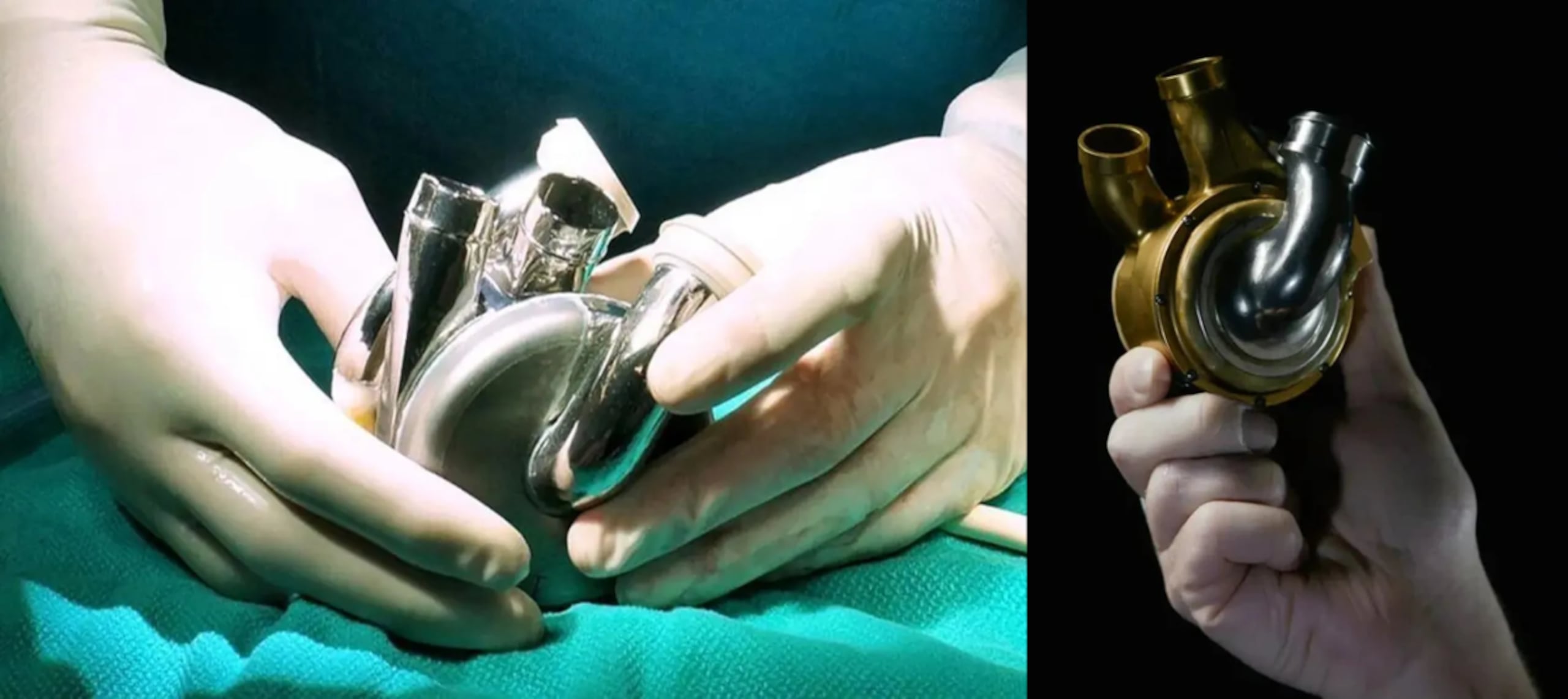 Hombre sobrevivió 100 días con un corazón artificial de titanio antes de recibir un trasplante.