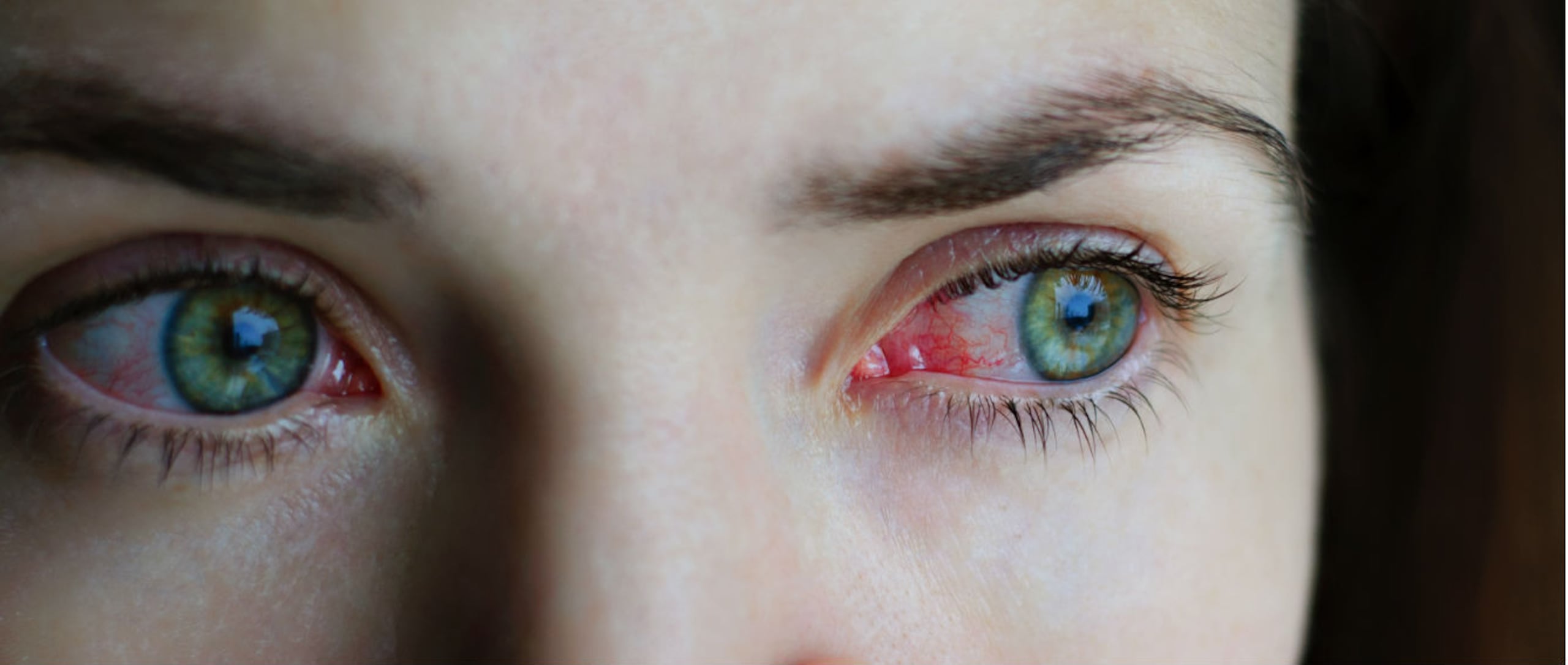 La conjuntivitis viral es la más contagiosa porque se propaga a través del contacto directo de dedos contaminados, instrumentos o artículos personales.(Shutterstock)