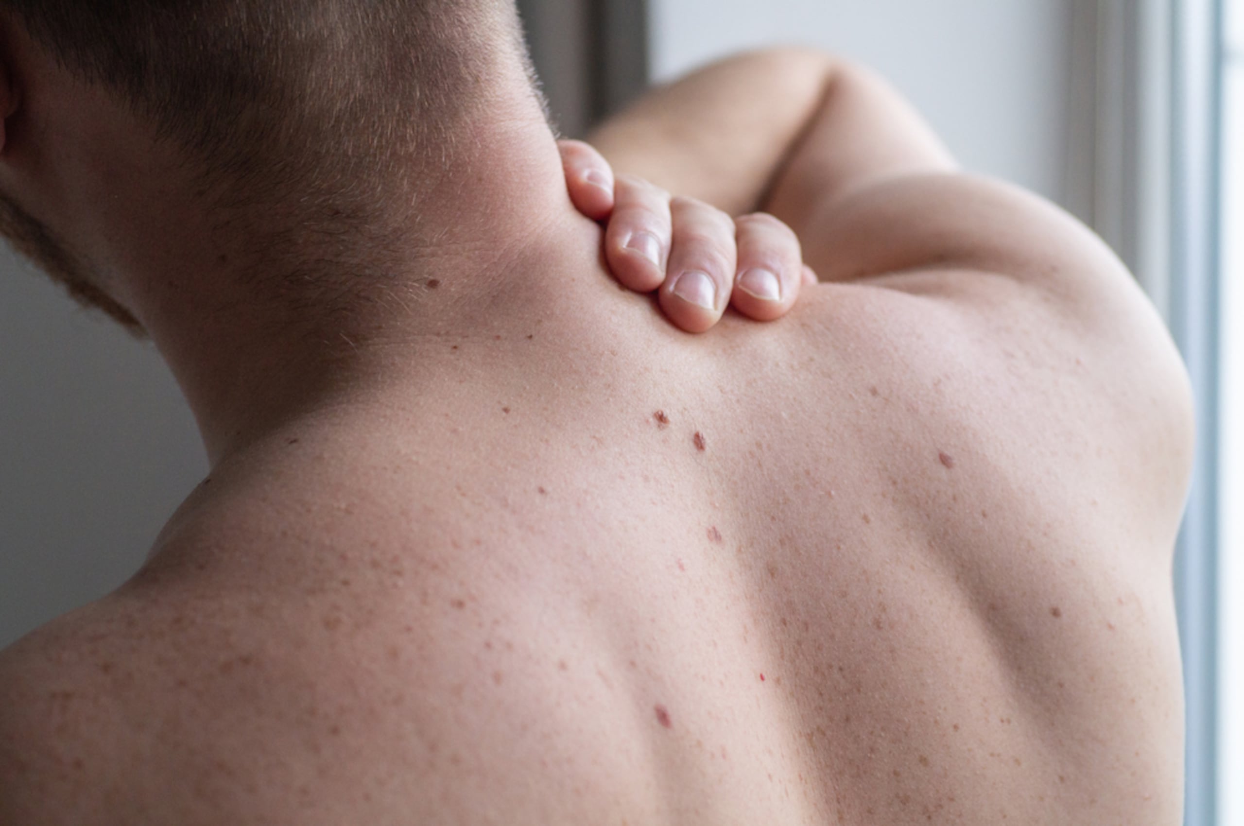 La exposición solar es uno de los principales factores de riesgo del melanoma que surge en las células encargadas de producir el pigmento de la piel.