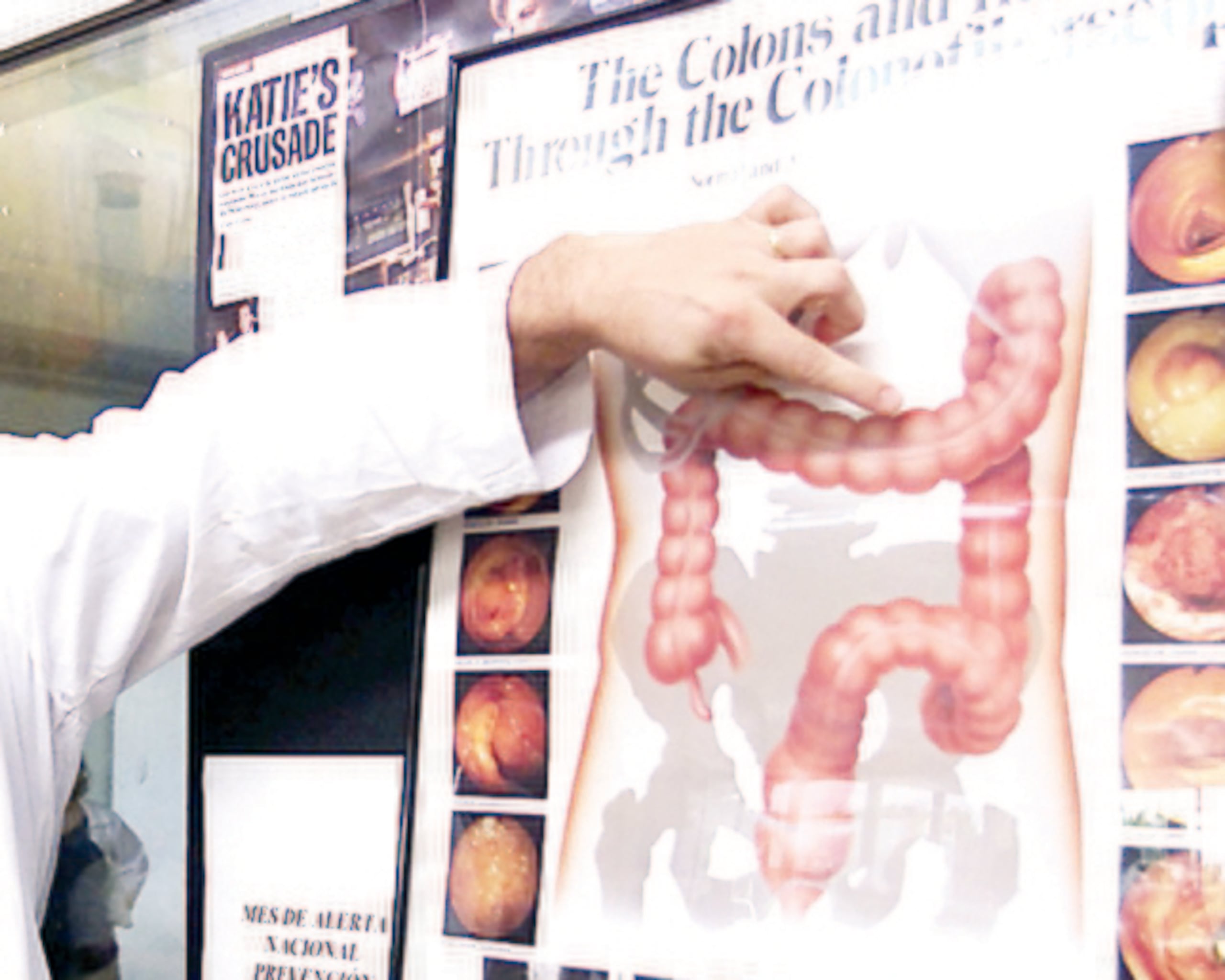 Las tasas de incidencia de cáncer de colon  fueron más altas en Europa, Australia y Nueva Zelandia, y las tasas de mortalidad más elevadas en Europa oriental, es decir, en países como Bulgaria, Eslovaquia, Hungría, Polonia, entre otros.