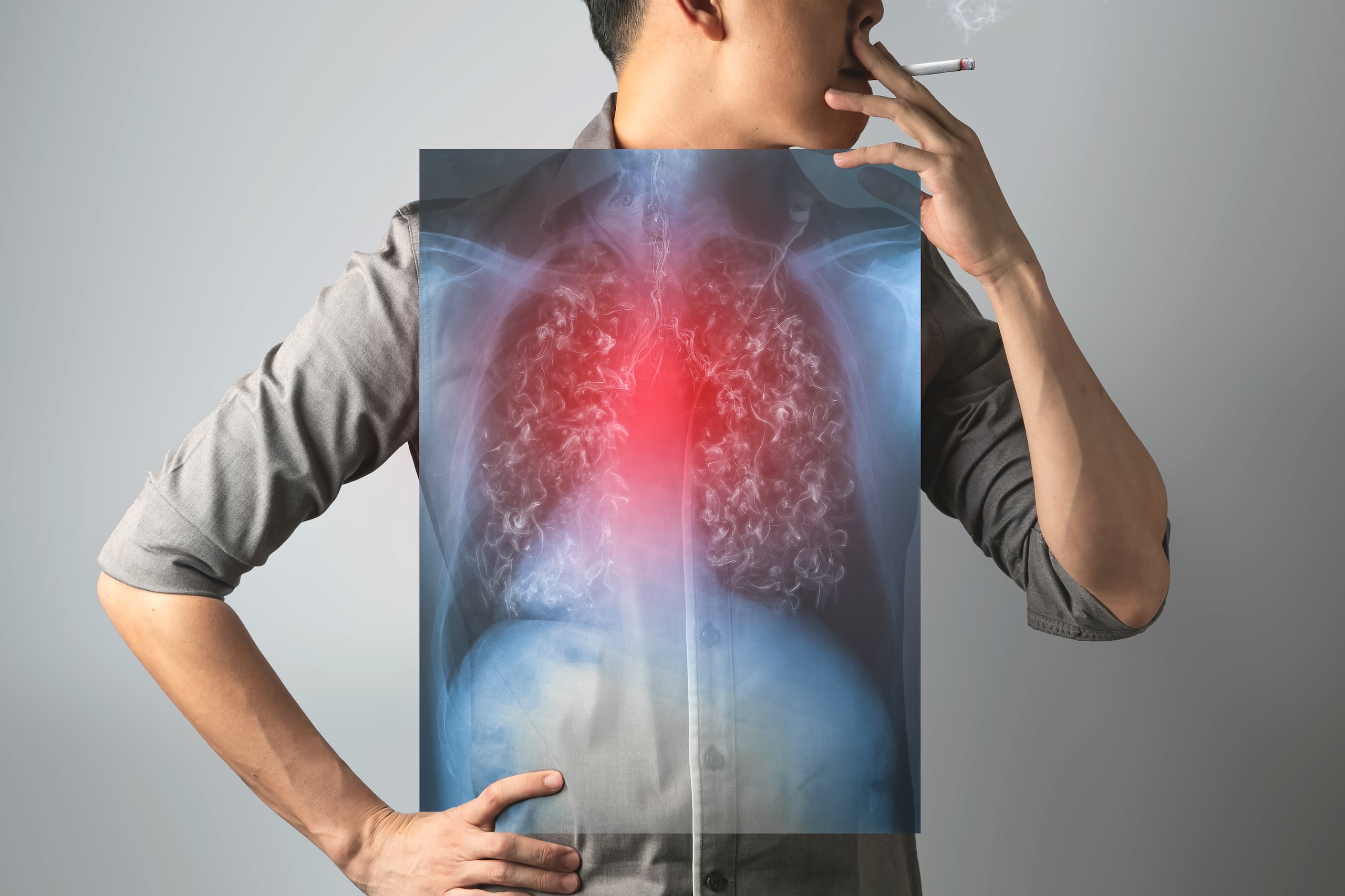 El tabaquismo y la exposición al humo de segunda mano son dos de los principales factores de riesgo de cáncer de pulmón.