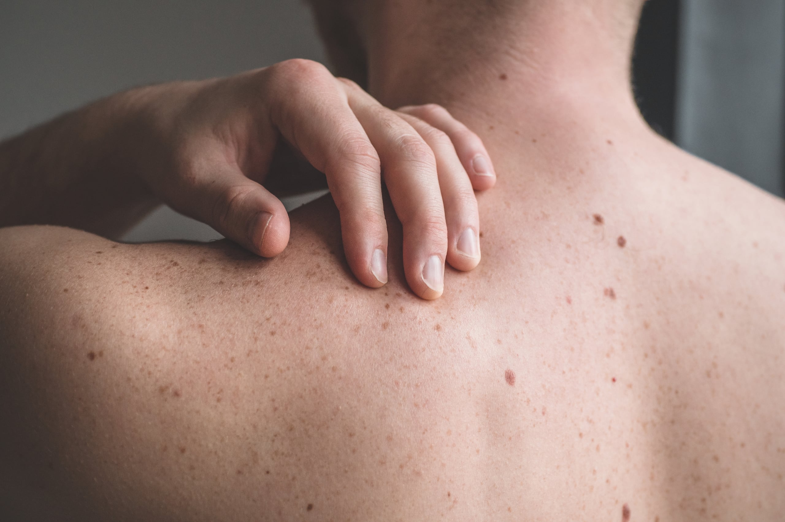 De los tipos de cáncer de piel, el melanoma es el que tiene mayor potencial de propagarse a otras partes del cuerpo.