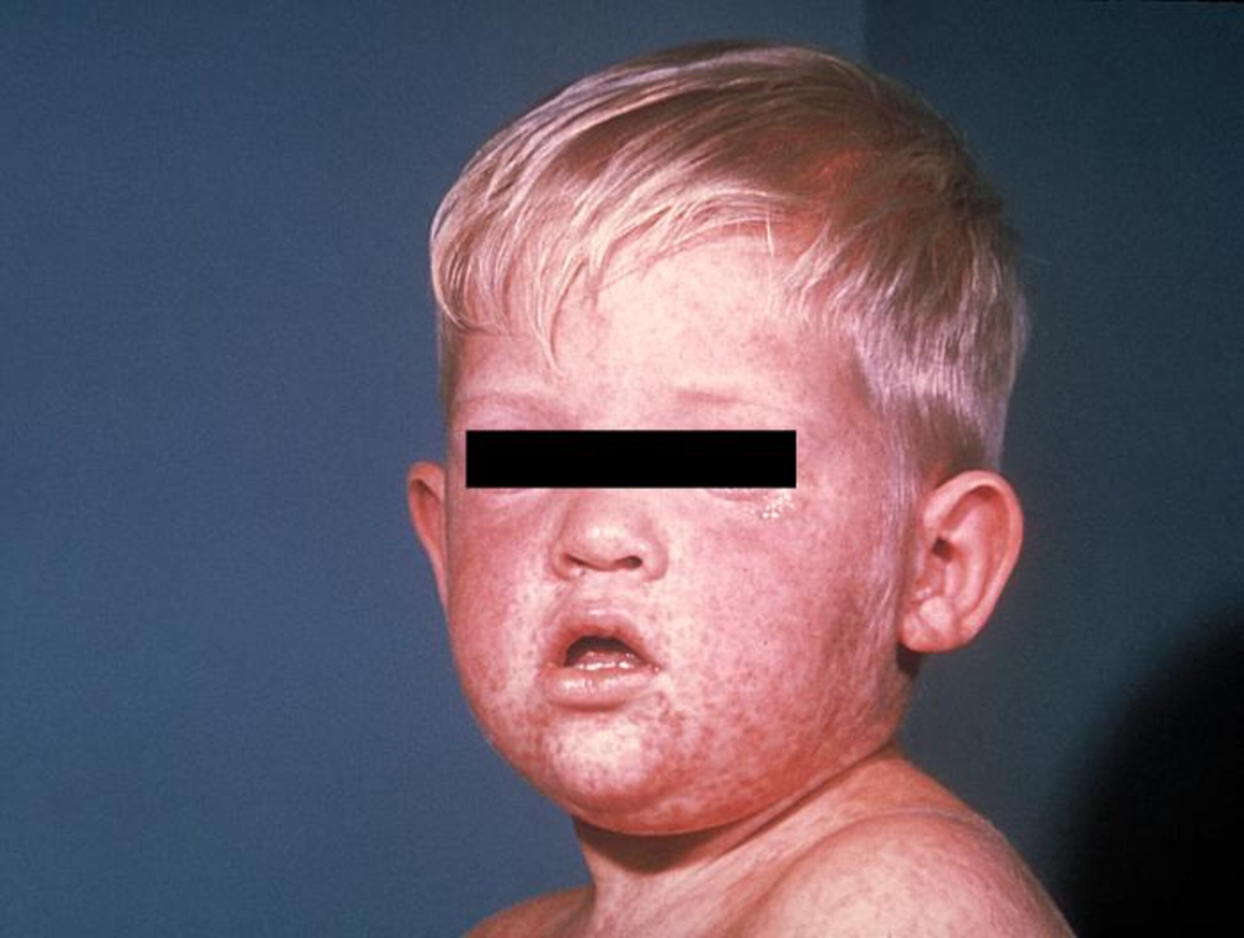 El tema de las vacunas ganó prominencia en Estados Unidos esta semana cuando tres aspirantes republicanos a la presidencia parecieron alinearse con quienes se niegan a vacunar a sus hijos. (cdc.gov/measles/about/photos-sp.html)