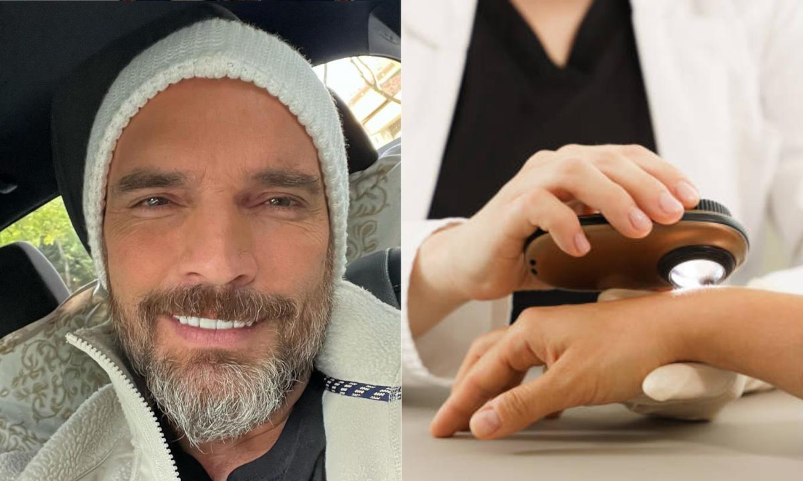 El cáncer de piel generalmente se desarrolla en áreas expuestas al sol.