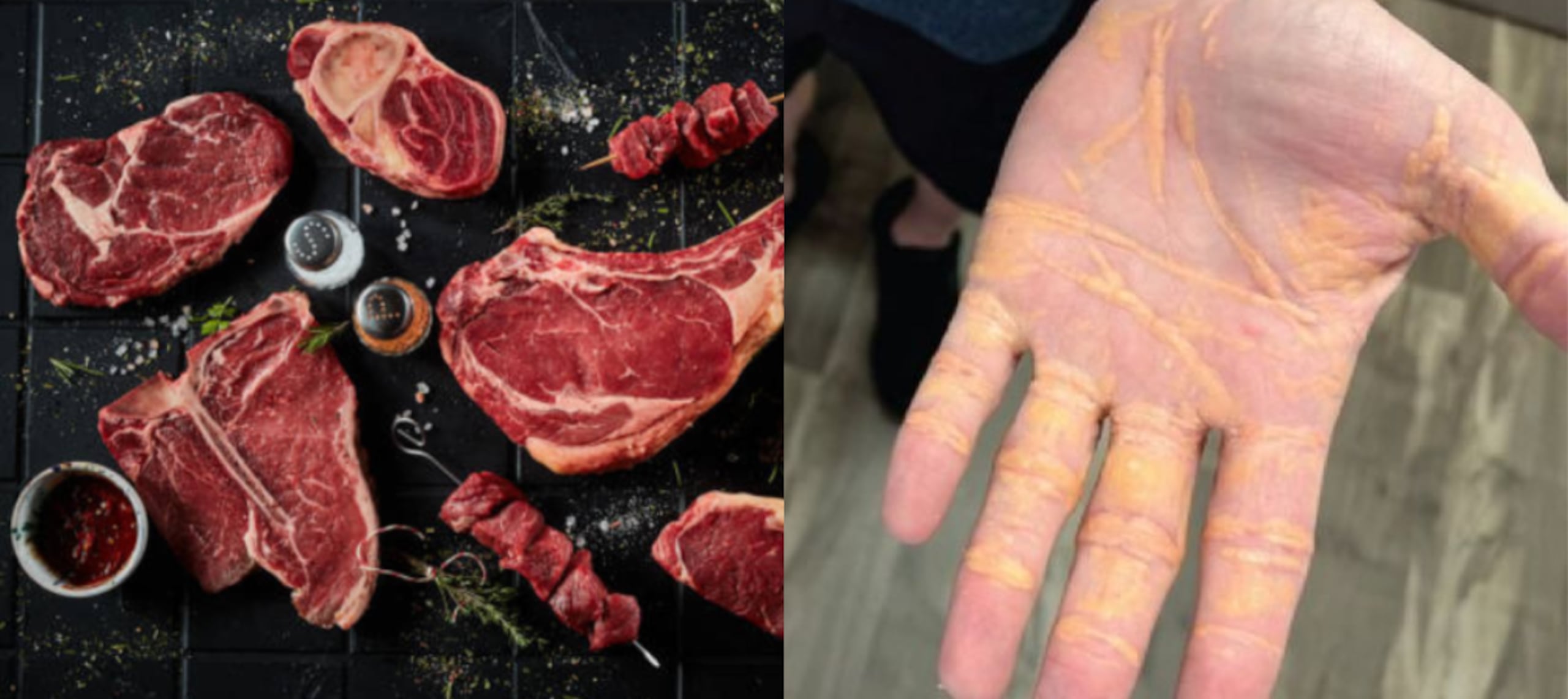 Una dieta alta en grasas llevó a un hombre a sufrir una rara afección cutánea por niveles elevados de lípidos.