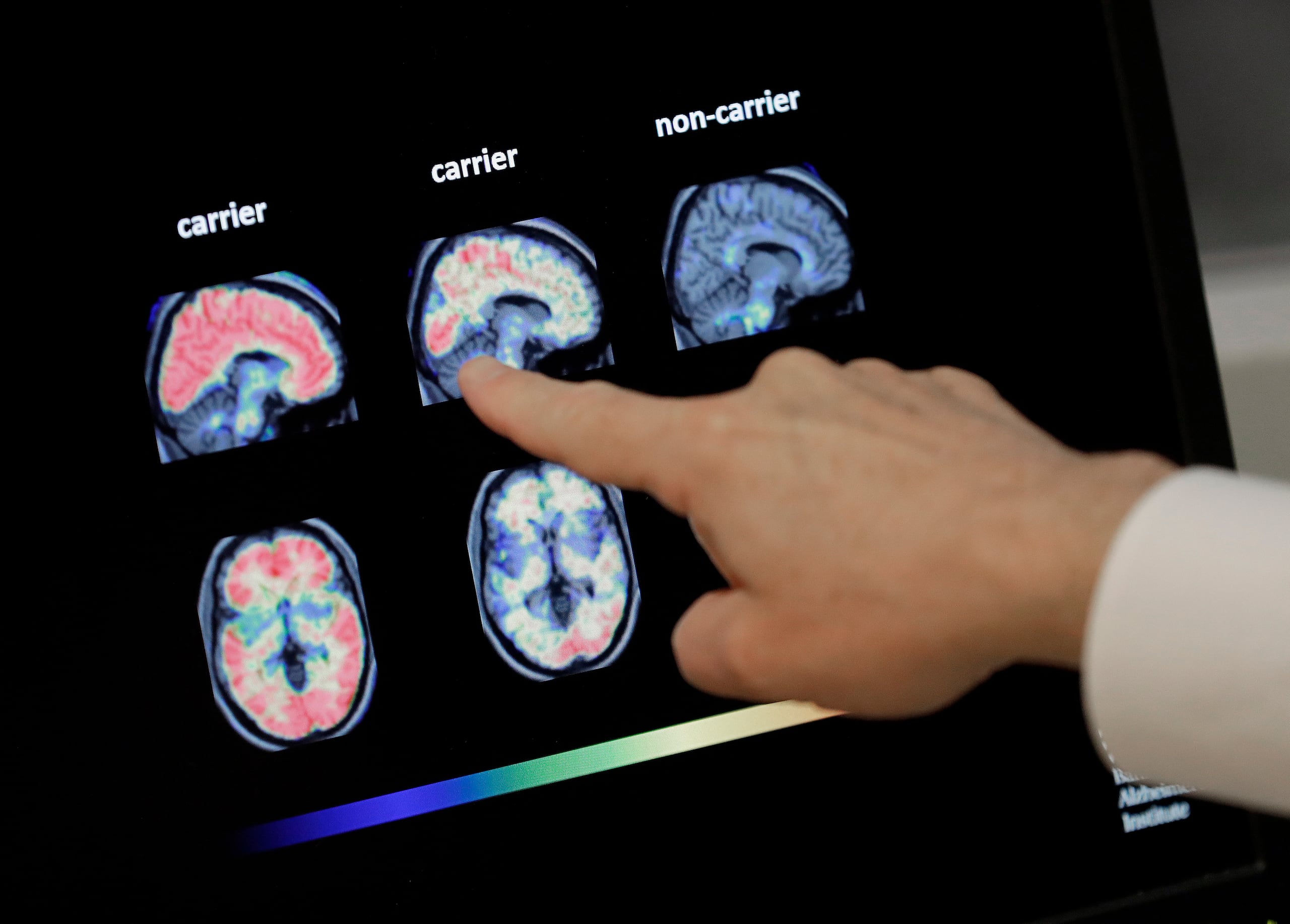 Un médico revisa una tomografía del cerebro en el Instituto Banner sobre Alzheimer en Phoenix, el 14 de agosto de 2018. (AP Foto/Matt York, archivo)