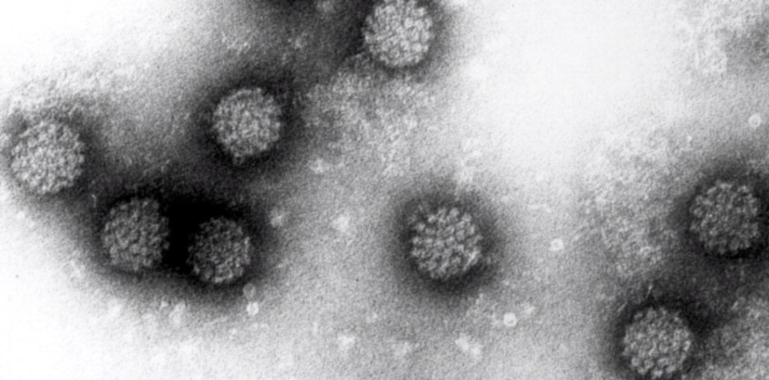 El Virus del Papiloma Humano (VPH) es más conocido por causar el cáncer de cuello uterino, pero los expertos dicen que también es una causa creciente de ciertos tipos de cáncer de boca. (Archivo)