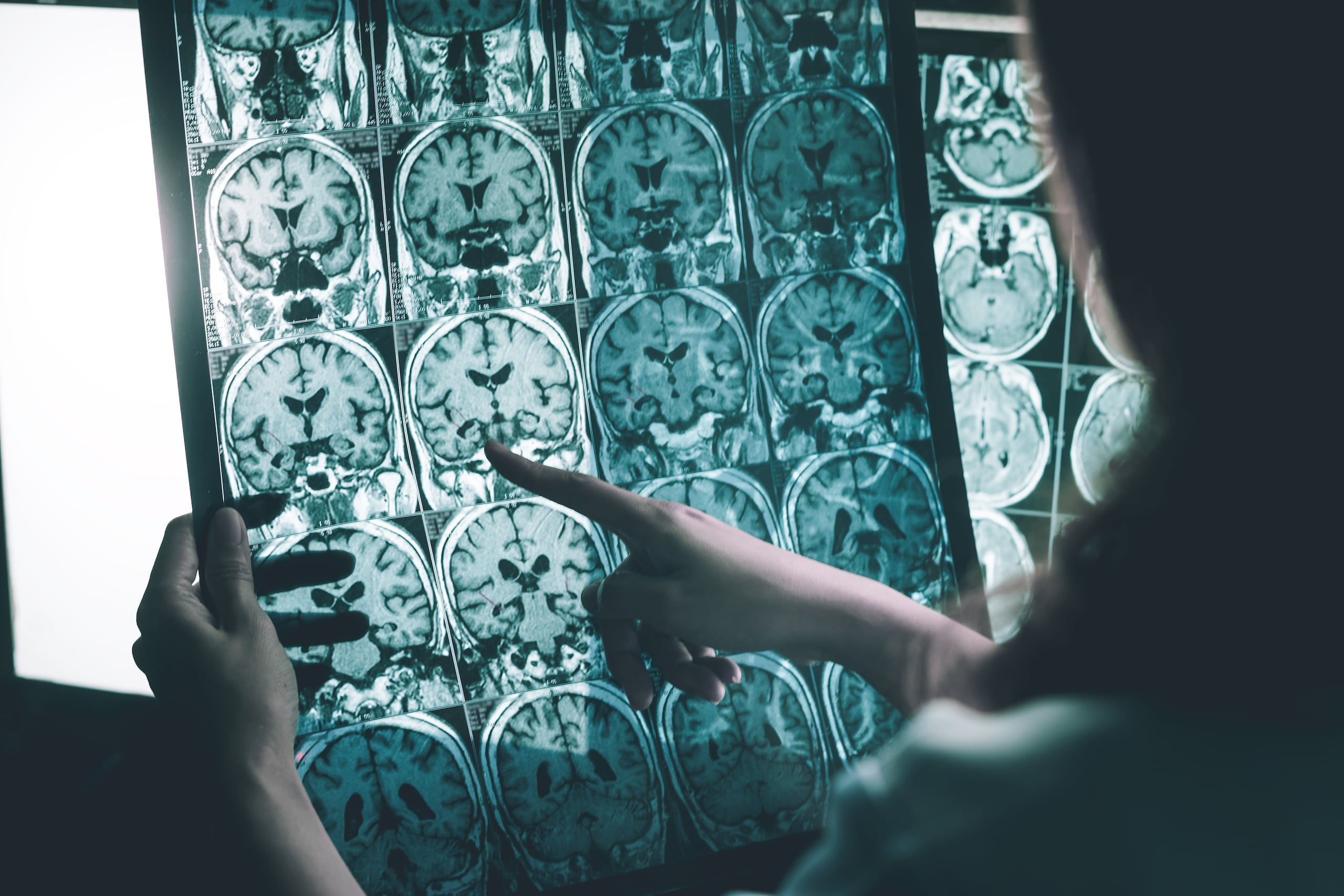 Examen de resonancia magnética del cerebro