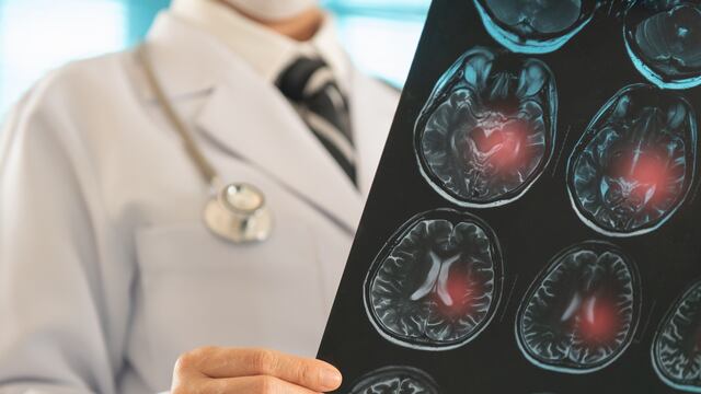 Unidad especializada en “stroke” en Bayamón mejora la atención a emergencias cerebrovasculares