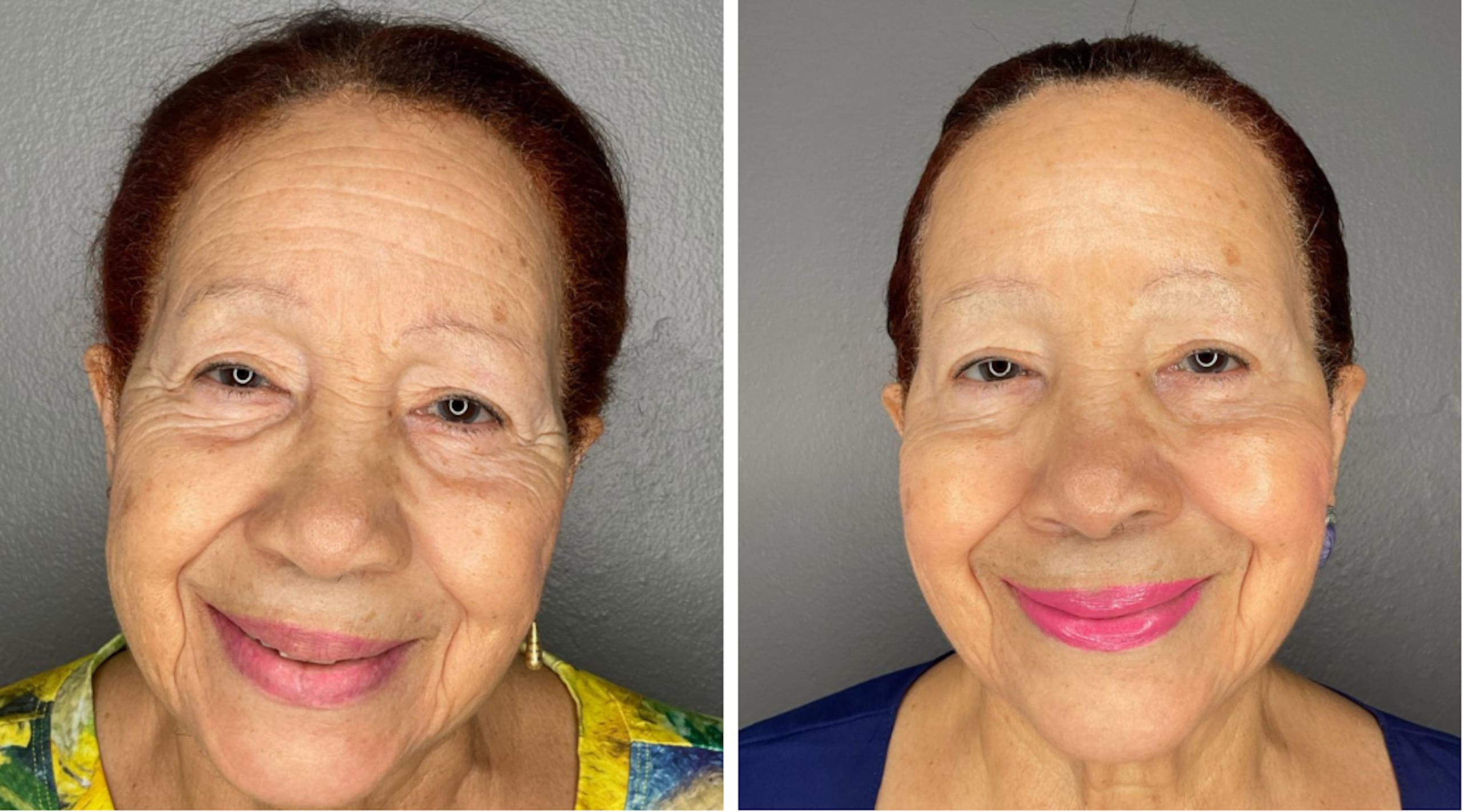 Los hilos tensores pueden levantar diversas áreas del rostro sin tener que recurrir al bisturí.