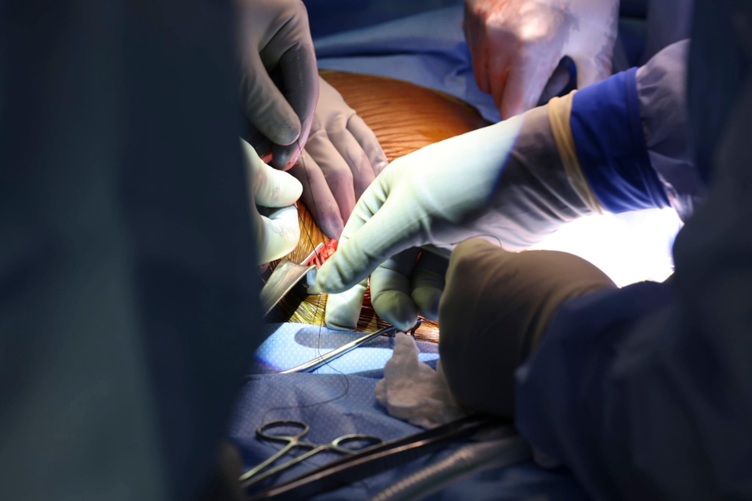 Cirujanos realizan el primer trasplante de riñón de cerdo genéticamente modificado a un ser humano vivo en el Hospital General de Massachusetts el 16 de marzo de 2024.