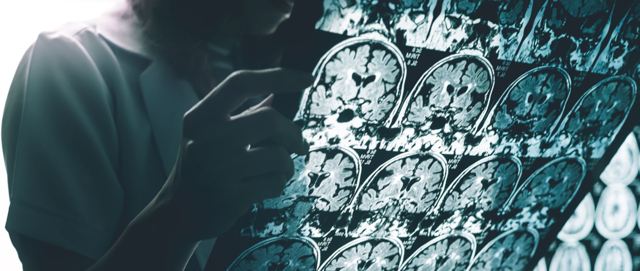 Los biomarcadores más estudiados en la enfermedad de Alzheimer incluyen los estudios de imágenes del cerebro, como resonancia magnética (MRI). (Shutterstock)