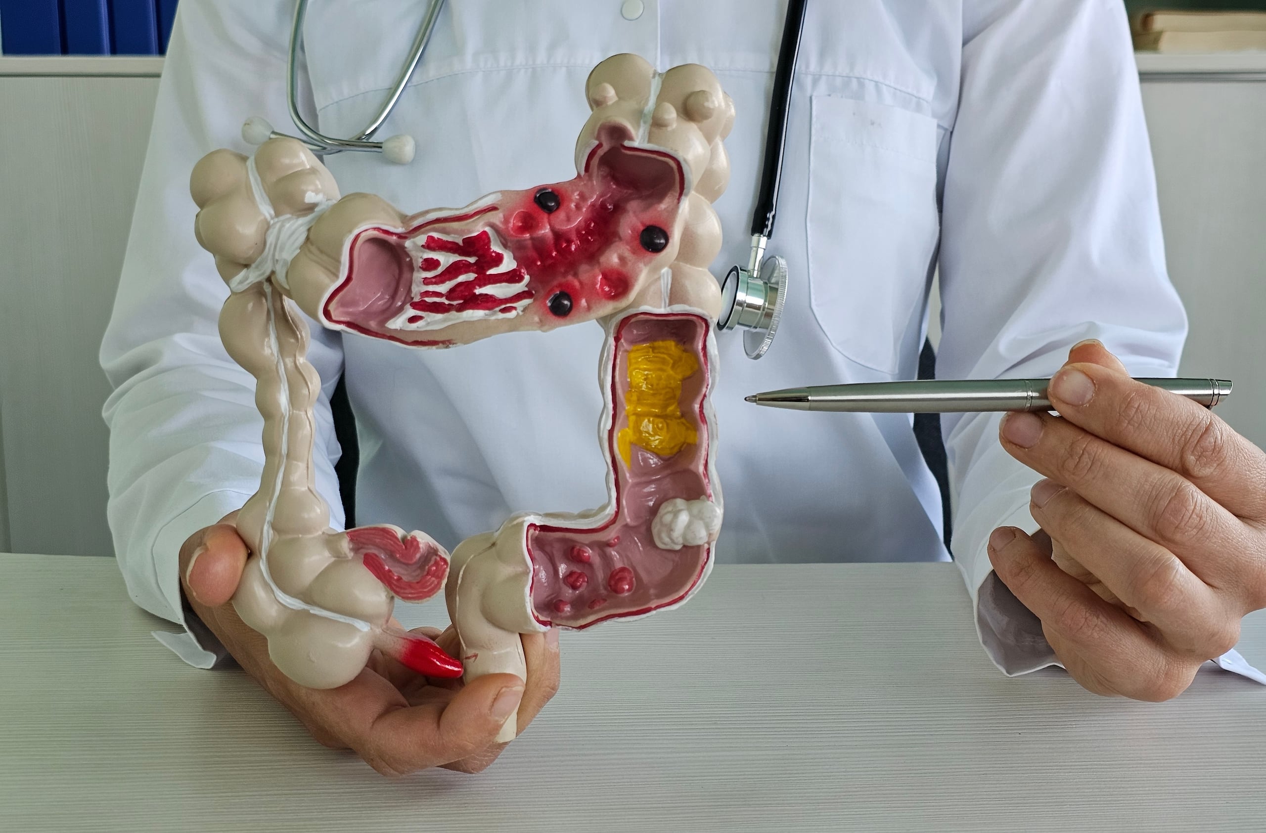 Si se diagnostica cáncer colorrectal, el tratamiento depende de dónde se encuentre, de cuánto se ha extendido y de las características de cada persona.