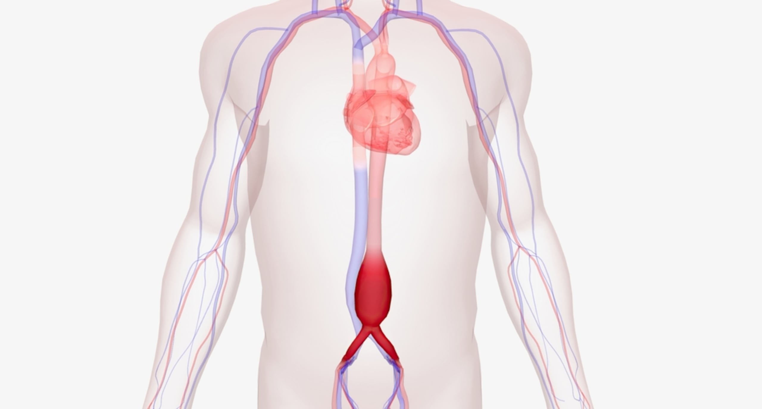 Los datos clínicos indican que el aneurisma aórtico abdominal afecta principalmente a hombres mayores de 65 años.