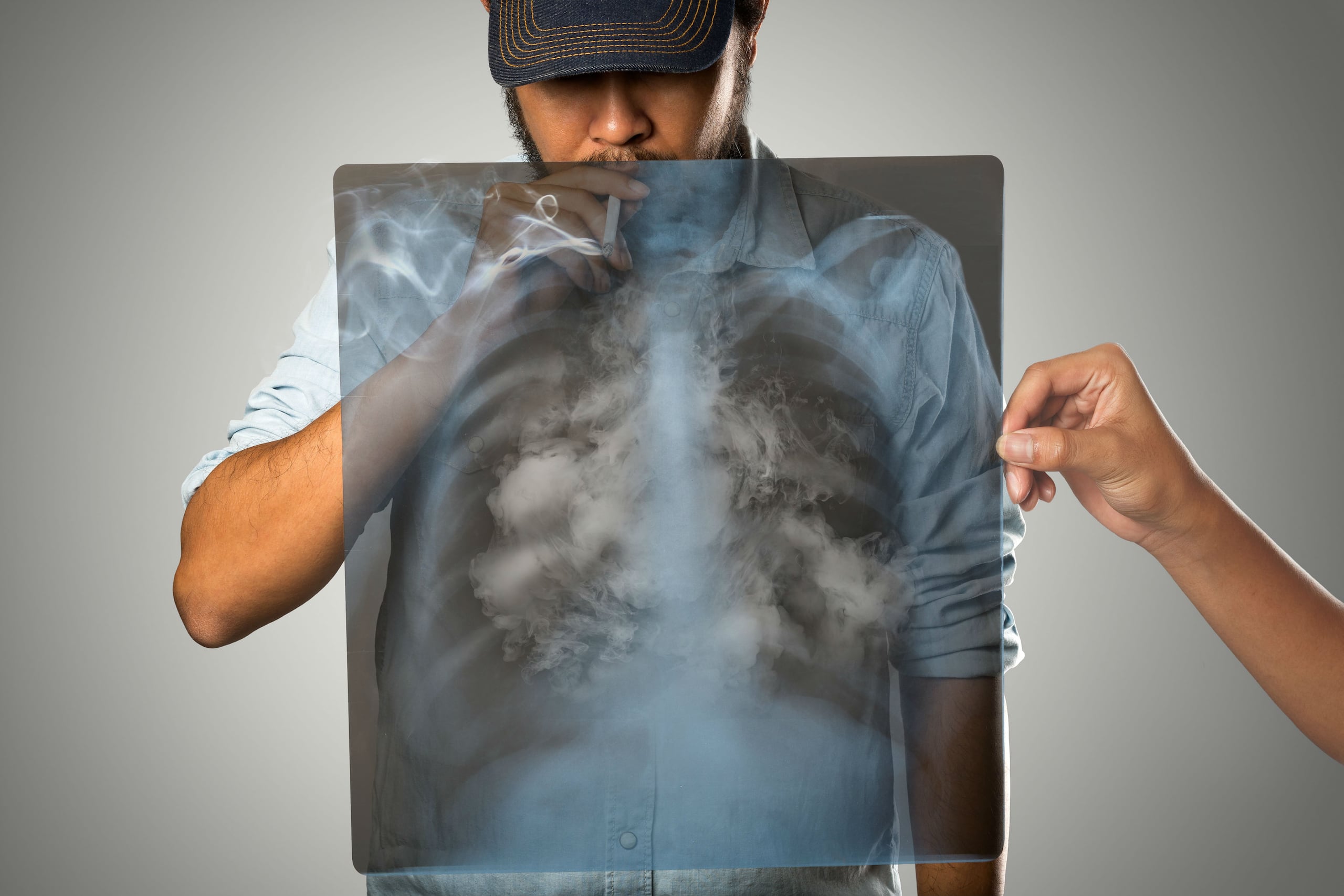 Fumar es la principal causa de cáncer de pulmón. (Foto Shutterstock)