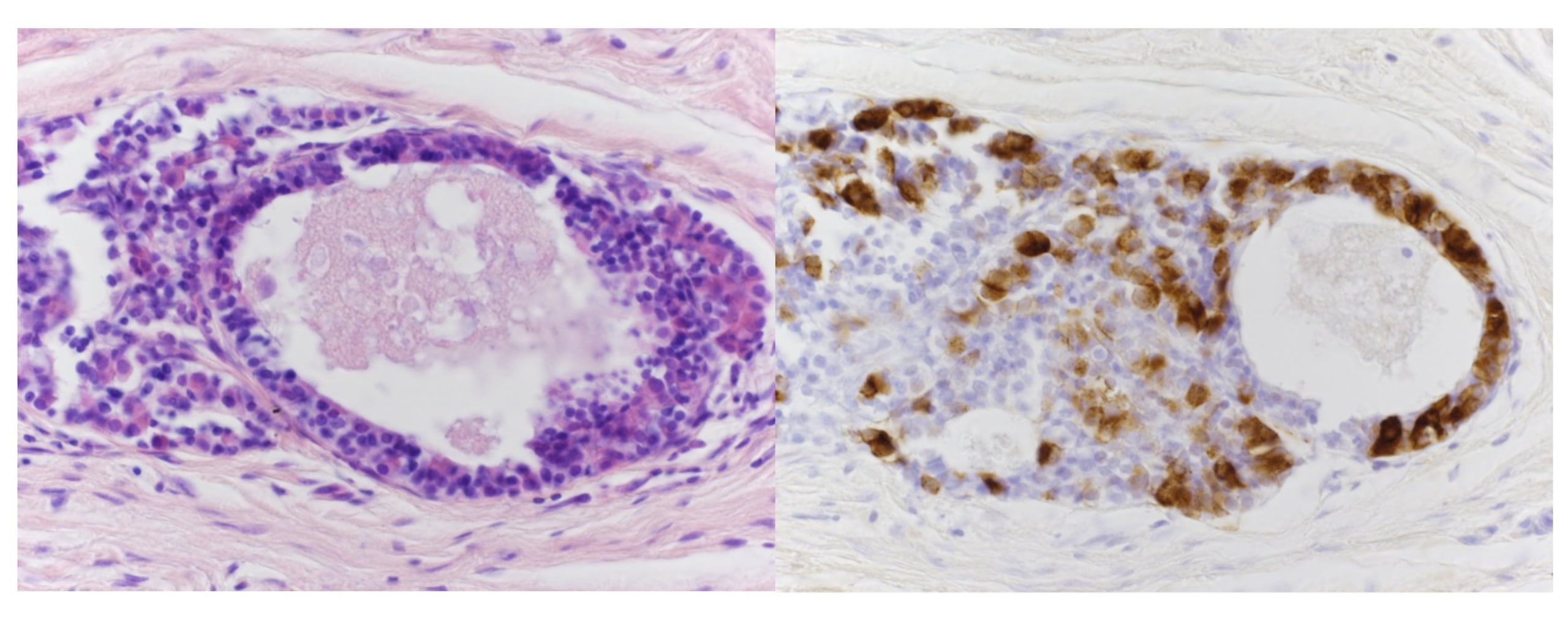 Estructura tisular que muestra el cúmulo de células trasplantadas dentro del tejido circundante. Derecha: La misma región teñida para detectar ACTH, la hormona que estas células hipofisarias producen de forma natural. La tinción marrón indica producción activa de ACTH, lo que confirma que las células permanecieron funcionales a pesar del rechazo inmunitario en curso. Crédito: Kondo et al., 2026