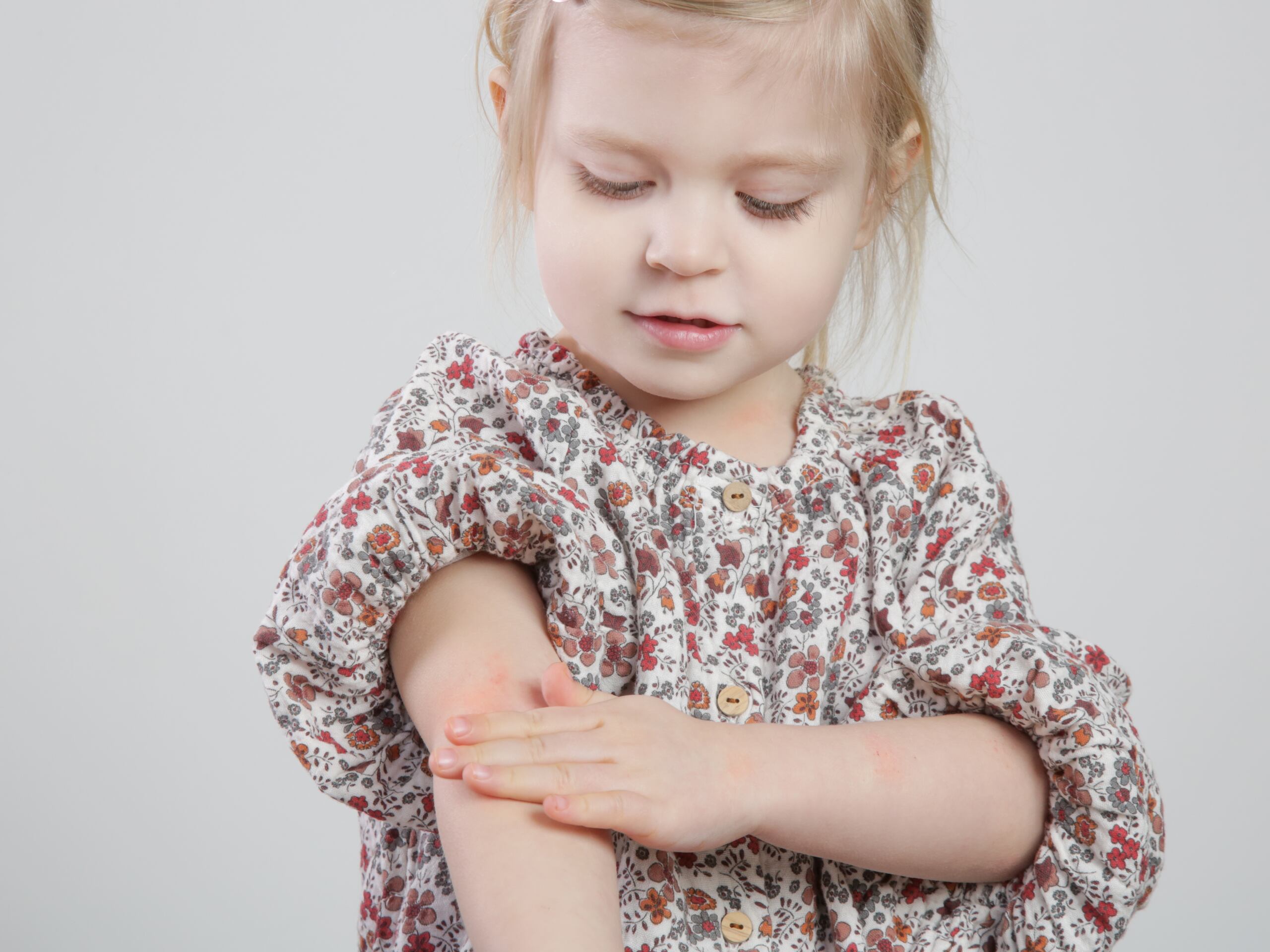 Generalmente, la dermatitis atópica aparece antes de los 5 años, con un pico entre los 2 y 6 meses de vida.