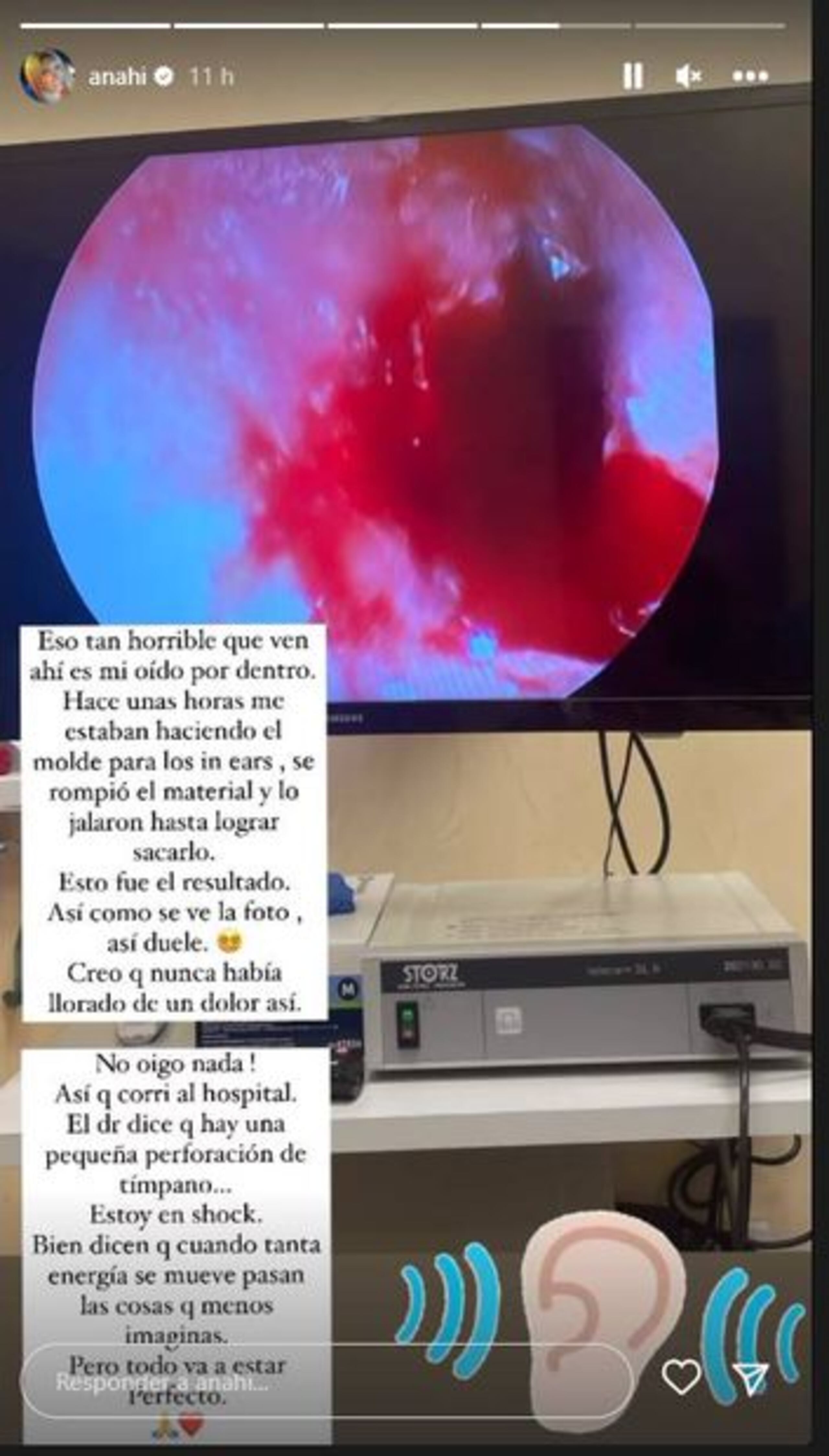 Anahí mostró las impactantes imágenes de su tímpano perforado en sus redes sociales.