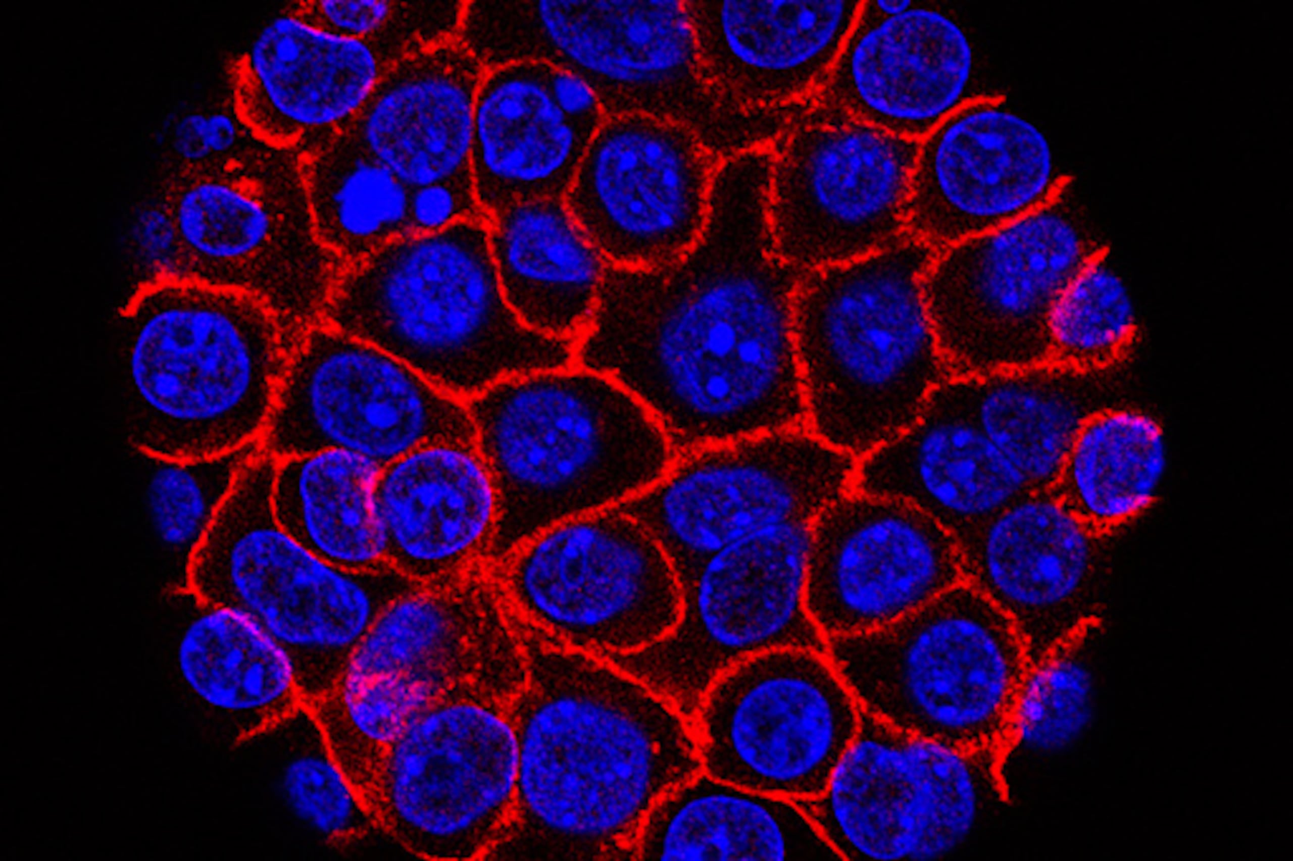 ARCHIVO - Esta imagen de microscopio sin fecha de la USC a través de los NIH muestra células de cáncer de páncreas, núcleos en azul, creciendo como una esfera envuelta en membranas, en rojo. (Min Yu/Eli and Edythe Broad Center for Regenerative Medicine and Stem Cell Research at USC, USC Norris Comprehensive Cancer Center, Archivo)