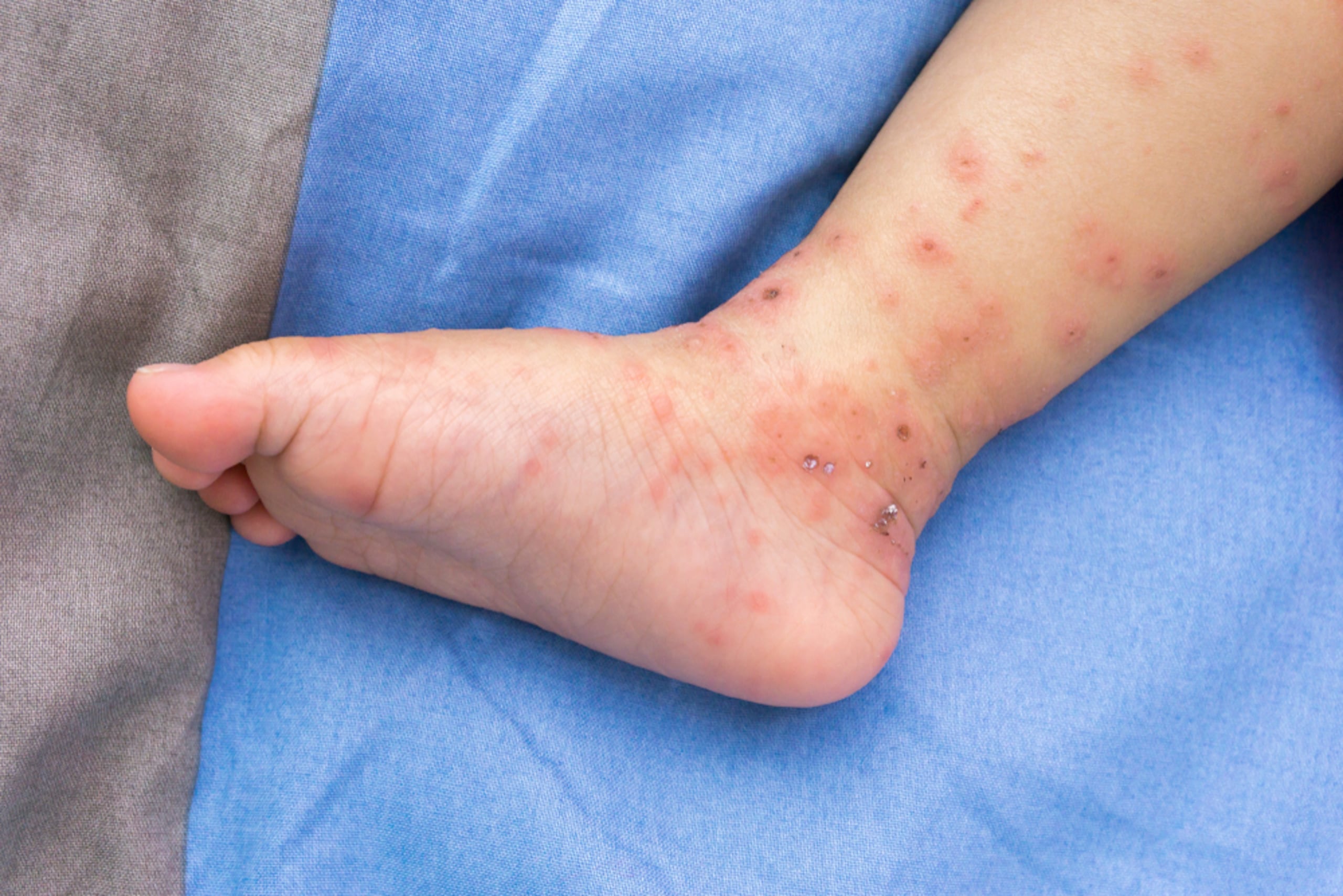 El síndrome de manos, pies y boca suele ser benigno y autolimitado.