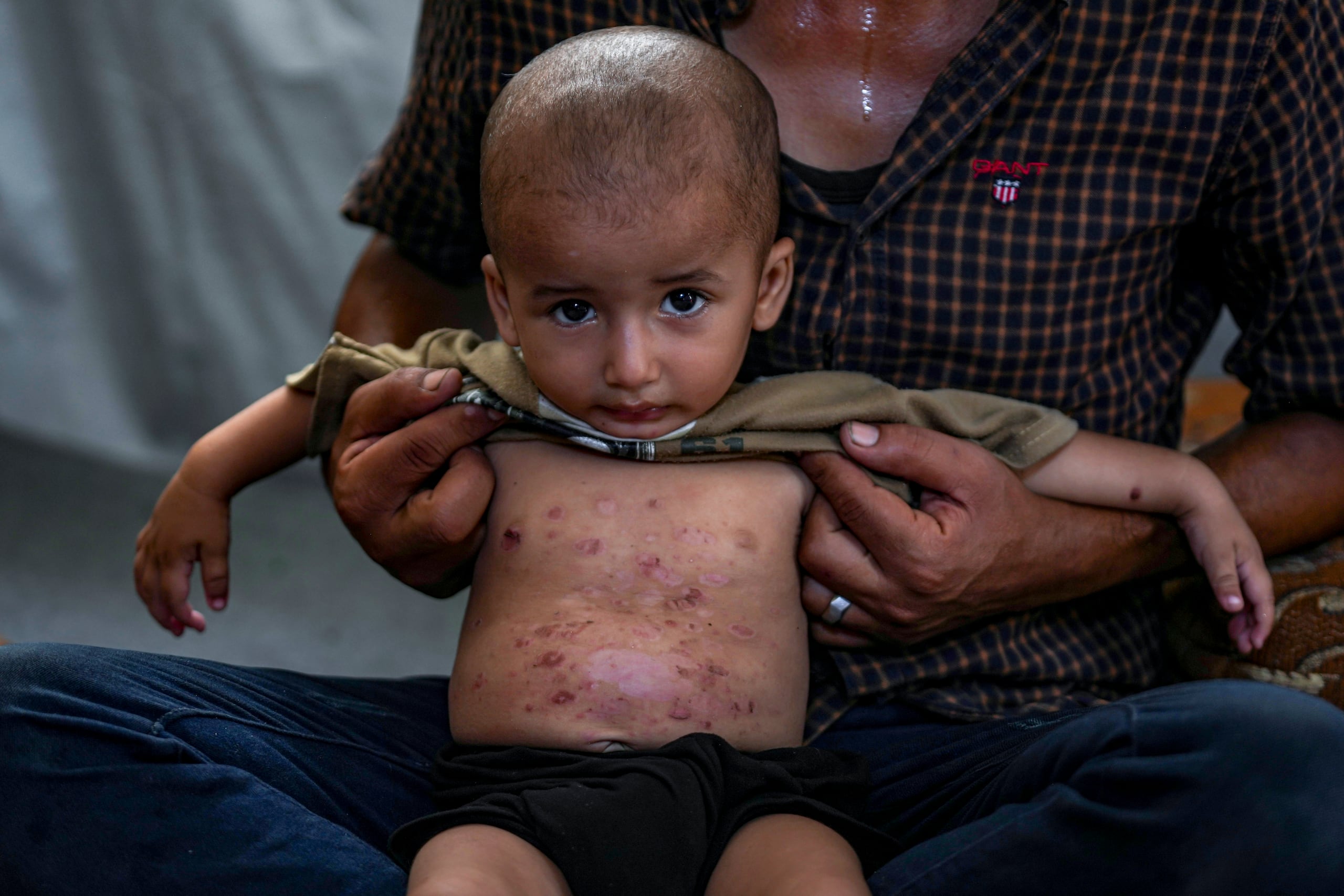 Mohammed Abu Obaid, un niño palestino que padece una enfermedad de la piel, posa para una fotografía junto a su padre en un campamento para desplazados por la guerra en Deir al-Balah, Franja de Gaza.